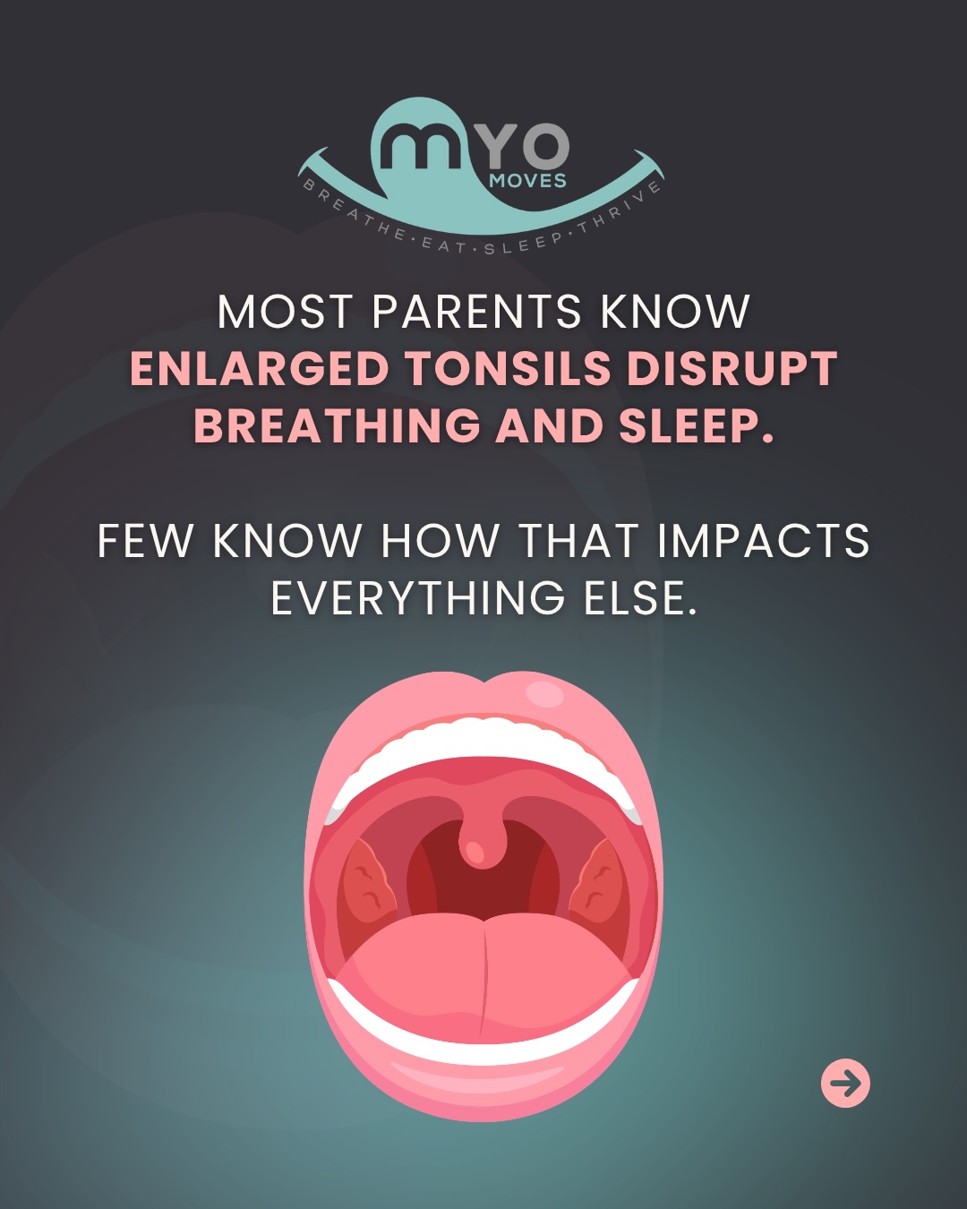 If your child snores, mouth breathes at night, or wakes up exhausted and irritable, enlarged tonsils and adenoids are worth a serious look.
When tonsils and adenoids block the airway, kids shift to mouth breathing to cope. Mouth breathing drops the tongue low. A low tongue means the palate doesn’t grow wide. A narrow palate shrinks the airway further. And a child running on poor sleep often looks like this:
✔ Hyperactive or impossible to settle
✔ Emotional outbursts that seem out of nowhere
✔ Trouble focusing at school
✔ Wired at bedtime, exhausted by morning
Those symptoms get labeled a lot of things. The airway rarely comes up first.
Removing tonsils and adenoids is an important step. But surgery alone doesn’t undo the mouth breathing habit, the low tongue posture, or the narrow jaw that developed. Those patterns stay until they’re retrained.
That’s what myofunctional therapy does.
💬 Comment GUIDANCE to learn about our clinical evaluation at Myo Moves, where we look at the full picture and guide you toward the next best step for your child.
#myofunctionaltherapy #tonsils #adenoids #airwayhealth #mouthbreathing