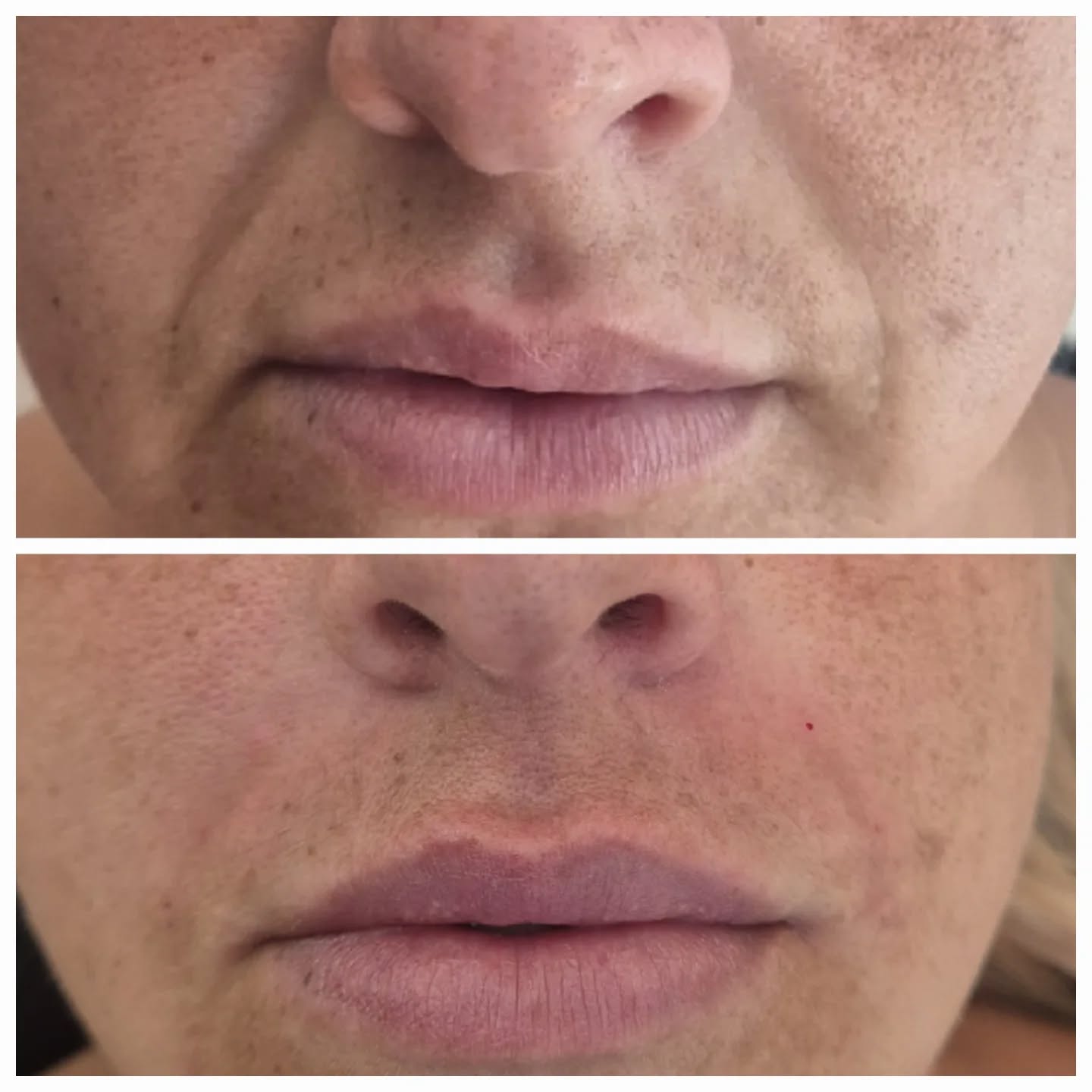 Softening, not changing 🤍
Nasolabial folds are a completely normal part of facial anatomy, but as we age we can lose volume and support in the mid-face, making these lines appear deeper.
A carefully placed dermal filler treatment can help restore support, soften shadows and create a fresher appearance while still keeping natural movement and expression.
The aim is never to erase every line, it’s to help you look like the best version of yourself ✨
Consultations available 🤍