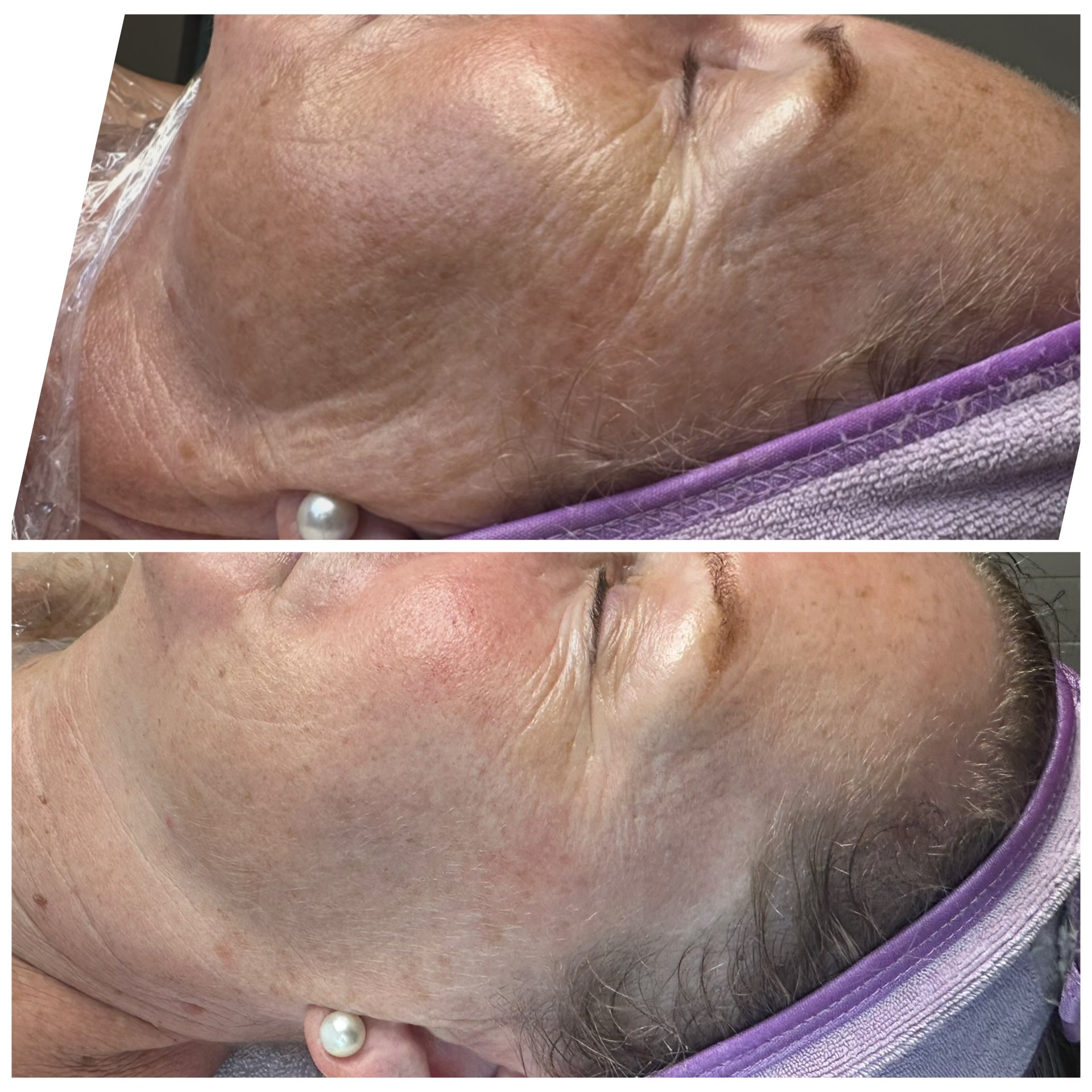 Skin transformation IN PROGRESS!!! Procell Microchanneling can transform your skin! By creating tiny channels in the skin, and infusing medical grade growth factor serum, the skin can change dramatically! Lighter, brighter and TIGHTER! With minimal downtime 1-3 days, THIS treatment keeps you winning in every way! Now available with exesomes and PDRN! #procellmicrochanneling #microneedlingyyc #microneedlingtherapy #yycskincare