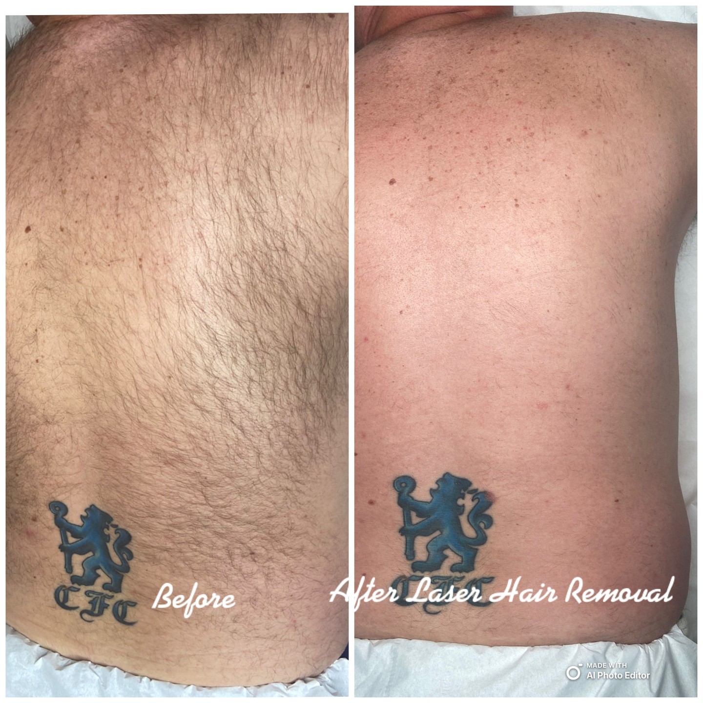Laser hair removal isn't just for the girls โจ
Look at these results on one of our male clients โ a beautifully smooth back after just a course of treatments with our AW3 Crystal Freeze Diamond laser.
No more shaving, no more ingrown hairs. Just smooth, confident skin that lasts. ๐
If you've been thinking about it, this is your sign. Laser hair removal works on ALL skin types and body areas โ and yes, it's safe around tattoos too!
Book your free consultation with Naz and let's get you started ๐
DM us or book online via the link in bio ๐
#LaserHairRemoval #MaleLaserTreatment #BeforeAndAfter #SmoothSkin #LaserHairRemovalDartford #BeautyByNaz #MensBeauty #AW3Laser #KentBeauty #HairRemoval #DartfordBeauty #MensGrooming #ConfidentSkin #SkinGoals
