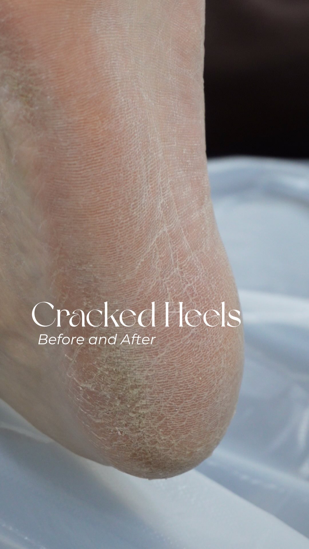 Wondering what your heels could potentially look like after treatment with us? 🤭🤭 Get in for your Deluxe Medical Grade Pedicure with our Podiatrist!
To book an appointment, contact us on 📞 0452 185 243 or book online via our website at www.hiptosolepodiatry.au 💻.
DISCLAIMER:
The recommendations made in this video are by a licensed Australian podiatrist under AHPRA. This video is for educational purposes and is not to persuade you of any particular treatment. If you have any concerns, please see a registered podiatrist. Treatment results may vary, individualised assessment is required.