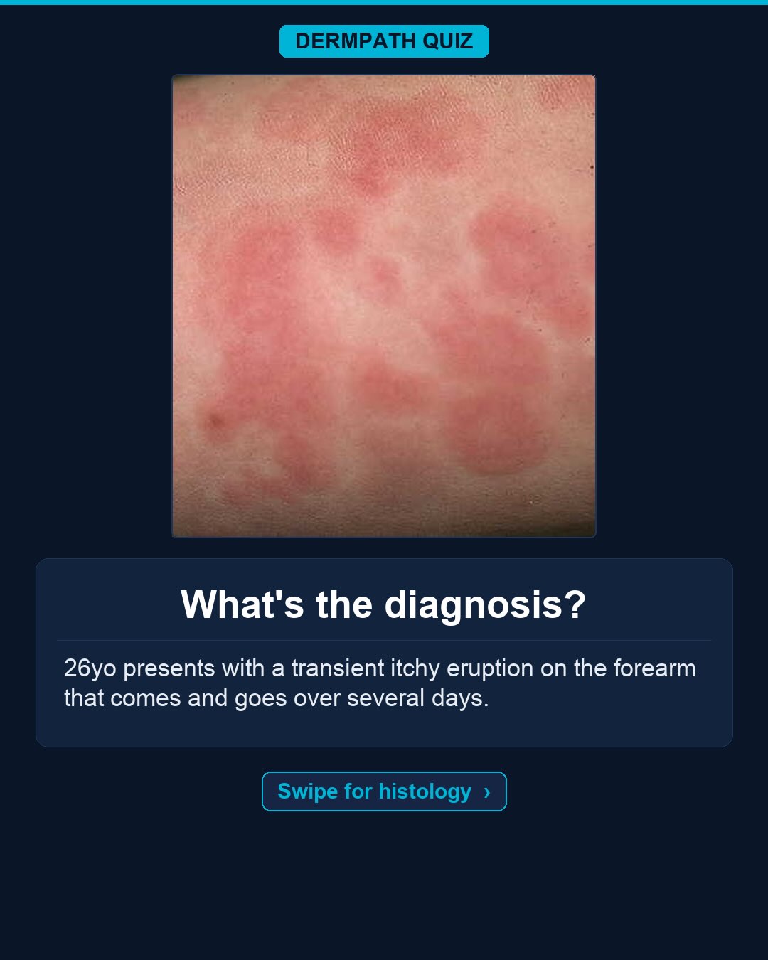 🔬 What’s the diagnosis?
The case: 26yo presents with a transient itchy eruption on the forearm that comes and goes over several days.
Study the clinical photo and the histology, then make your call. Keep swiping for the diagnosis, the labeled slides, and the high-yield pearls.
Your diagnosis? Drop it in the comments before you swipe to the answer 👇
Save this for board review and tag someone who would nail it. Follow for a new dermatopathology case every week.
