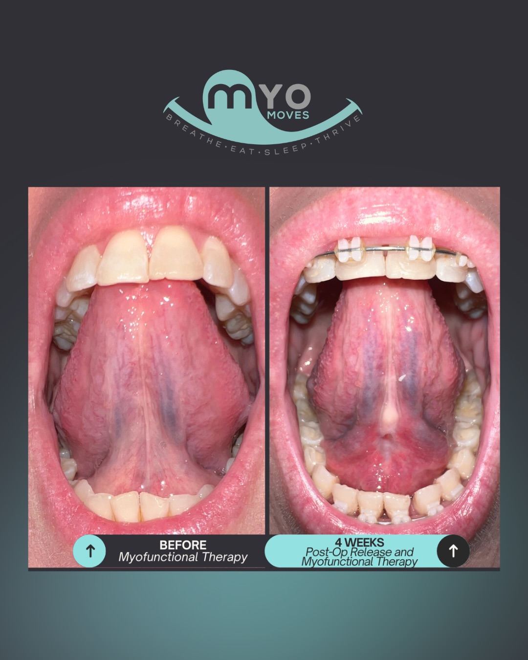 A 13mm Jump in 4 Weeks! 🤯 This is what real tongue-tie healing and progress looks like for a 51-year-old patient!
After a tongue-tie release and 11 focused myofunctional therapy sessions, the difference speaks for itself! 👅
This patient initially presented with low tongue tone and a history of keloid scarring, but we supported her recovery by introducing serrapeptase on day 15 to encourage healthy tissue remodeling. Her healing has been incredible!
The Functional Gains 📈:
🔹 MAX (Maximum Interincisal Distance): 38mm → 51mm
🔹 TIP (Tongue on the Spot): 36mm → 46mm
🔹 LPS (Suction Hold): 32mm → 37mm
This is the power of a holistic approach where bodywork, release, and myo work together. 💪 It’s not only about more tongue movement, but also better function, improved airway, and quality of life!
If you’re looking for guidance on your own tongue-tie journey, comment GUIDANCE below and we’ll help you through the entire process.
#MyofunctionalTherapy #tonguetie #AirwayHealth #BeforeAndAfter #frenectomy