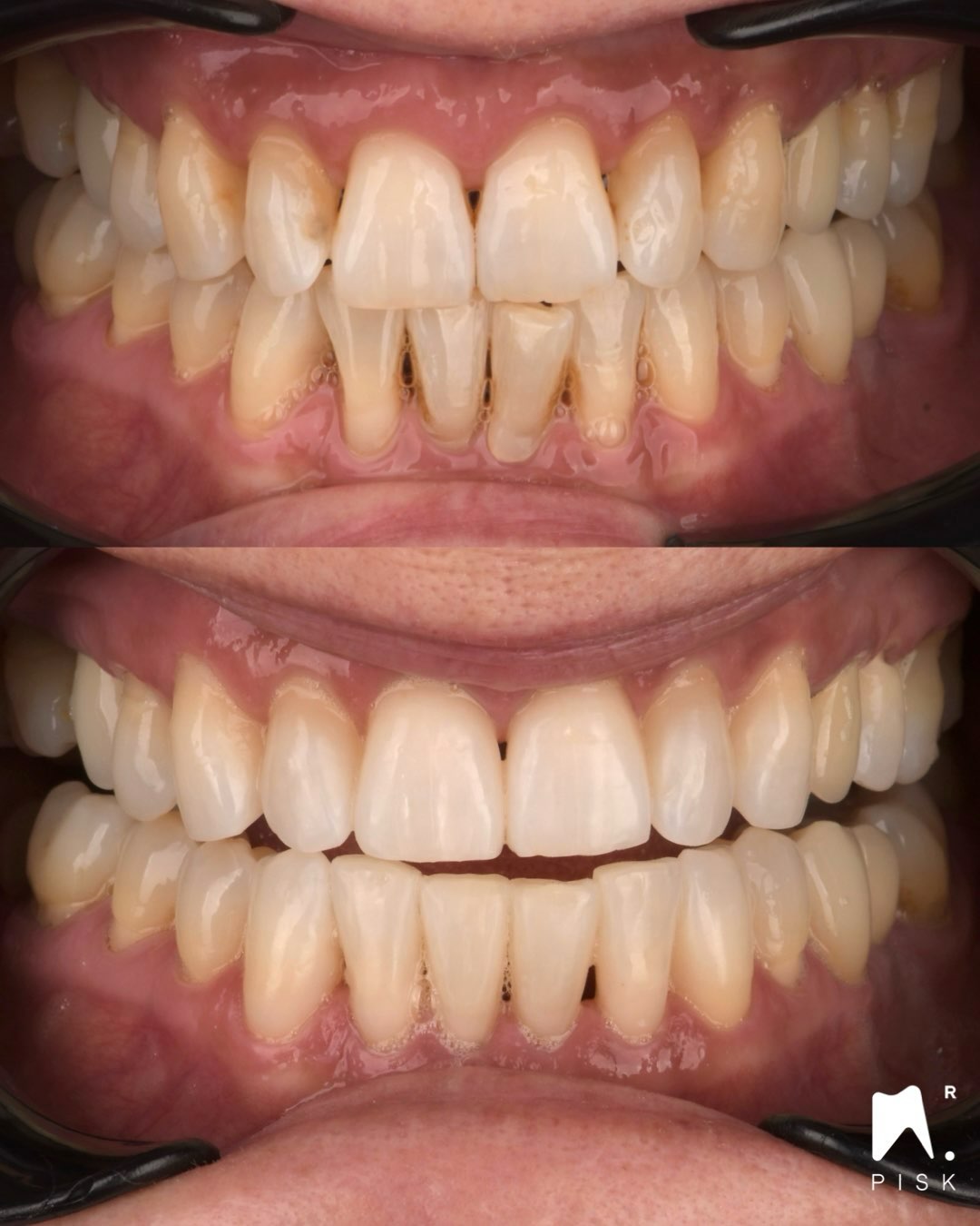 Closing black triangle ?
Injection or not ?
Do you want to learn about injection ? DM me ;)
Material : gaenial A’chord A1, A2
#No veneers #esthetique #lille #No facette