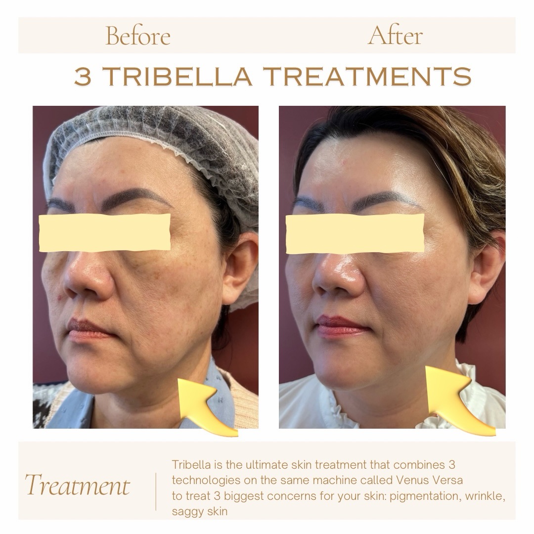 ✨ Never had a skin treatment before? Tribella is the perfect place to start your skin transformation.
If you’ve been looking in the mirror thinking, “I wish my skin looked fresher, brighter, and younger,” but you’re nervous about where to begin, Tribella could be exactly what you’re looking for.
At Fabulash Brows & Aesthetics, our advanced Venus Versa Tribella treatment combines three proven technologies in one session to target multiple concerns safely and effectively:
✨ Sun damage & pigmentation
✨ Redness & uneven skin tone
✨ Fine lines & wrinkles
✨ Enlarged pores
✨ Loss of firmness & dull skin
Unlike treatments that only focus on one concern, Tribella works on your skin from multiple angles, helping you achieve a noticeable, natural-looking makeover with minimal downtime.
Every treatment begins with a FREE professional skin consultation and advanced skin analysis, so we can personalise your treatment plan to your skin, your concerns, and your goals.
💖 If you’ve never invested in your skin before, this is your opportunity to do it with confidence, using medical-grade technology trusted by professionals around the world.
📍 Fabulash Brows & Aesthetics
Level 5, 76 Manners Street, Wellington
📲 Book your FREE consultation today:
🌐 www.fabulashbrows.co.nz
📞 022 130 8020
Your future skin starts with one consultation. Let us help you achieve the healthy, glowing skin you deserve.
#Tribella #VenusVersa #SkinMakeover #SkinRejuvenation #AntiAging