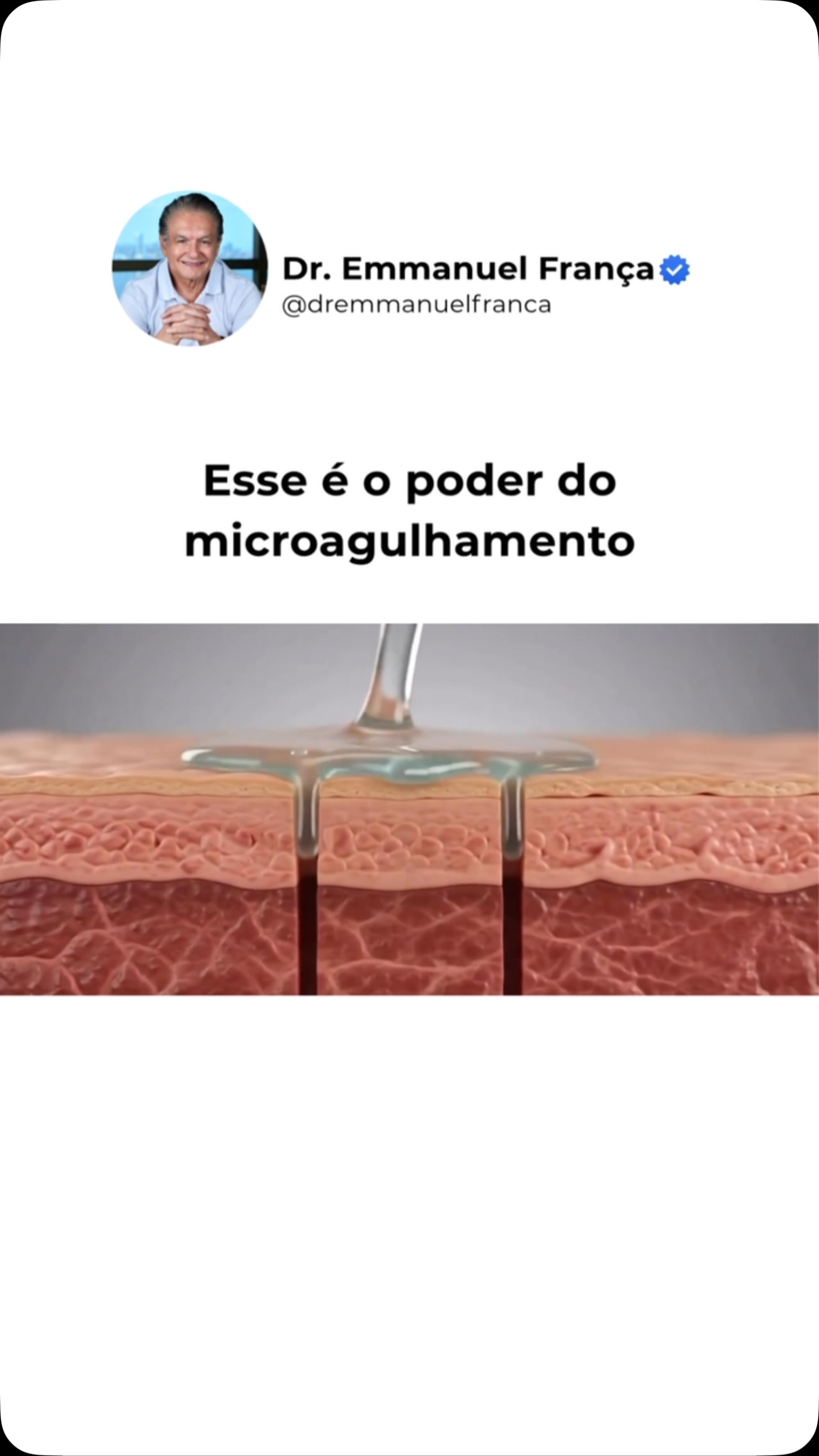 Muito além de pequenas agulhas, esse é um tratamento que estimula a pele a fazer aquilo que ela sabe de melhor: produzir colágeno e se renovar.
Com a técnica correta e a indicação adequada, o microagulhamento pode melhorar a textura da pele, suavizar cicatrizes de acne, reduzir poros dilatados, amenizar linhas finas e devolver mais firmeza e viço ao rosto.
O segredo não está apenas no procedimento, mas em uma avaliação individualizada e em um protocolo personalizado para cada paciente. Afinal, cada pele tem necessidades diferentes.
Agende sua avaliação e descubra se o microagulhamento é o tratamento ideal para você.
Dr Emmanuel França
Dermatologista
CRM 5999
RQE 636