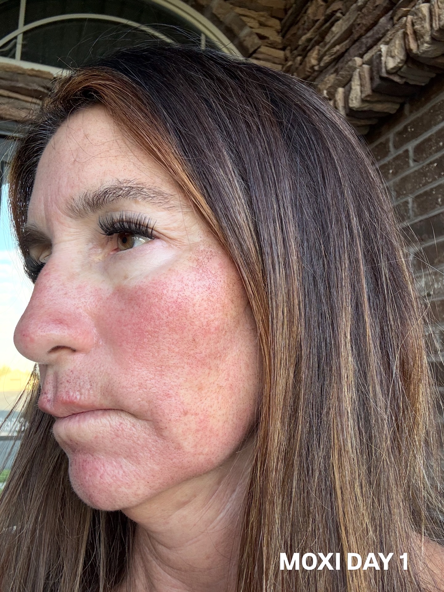MOXI Healing: Day 1 → Day 7
🎉 Tomorrow only at our 5-Year Anniversary Party: Purchase a MOXI treatment and get $100 OFF!
Swipe to see what the healing process looks like from day one through day seven. With just a little redness and tiny “coffee ground” spots during healing, you’ll be left with brighter, smoother, more even-looking skin.
MOXI helps improve sun damage, pigmentation, fine lines, and overall skin texture with minimal downtime.
#skinfx #medspa #moxitreatment #skintreatment #skincareutah