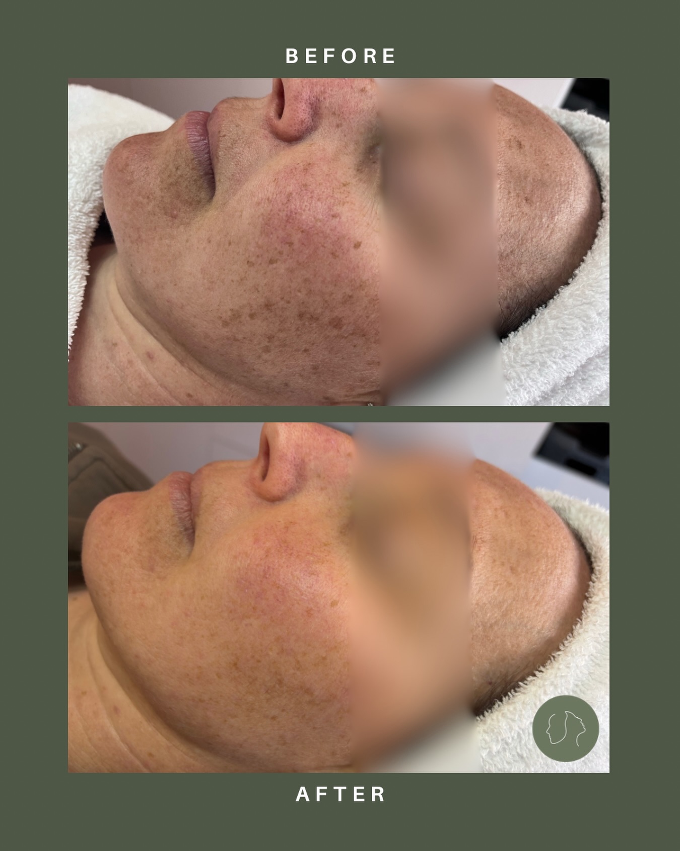 How incredible is this transformation? 🤩
Achieved with just one Pico Genesis treatment combined with a targeted spot treatment and a personalised Ultraceuticals home care routine. Together, they work to visibly reduce pigmentation, brighten the complexion and reveal healthier, more radiant skin.
Real results happen when advanced technology meets the right home care, and these results speak for themselves.
We are obsessed!
@cutera.anz @ultraceuticals