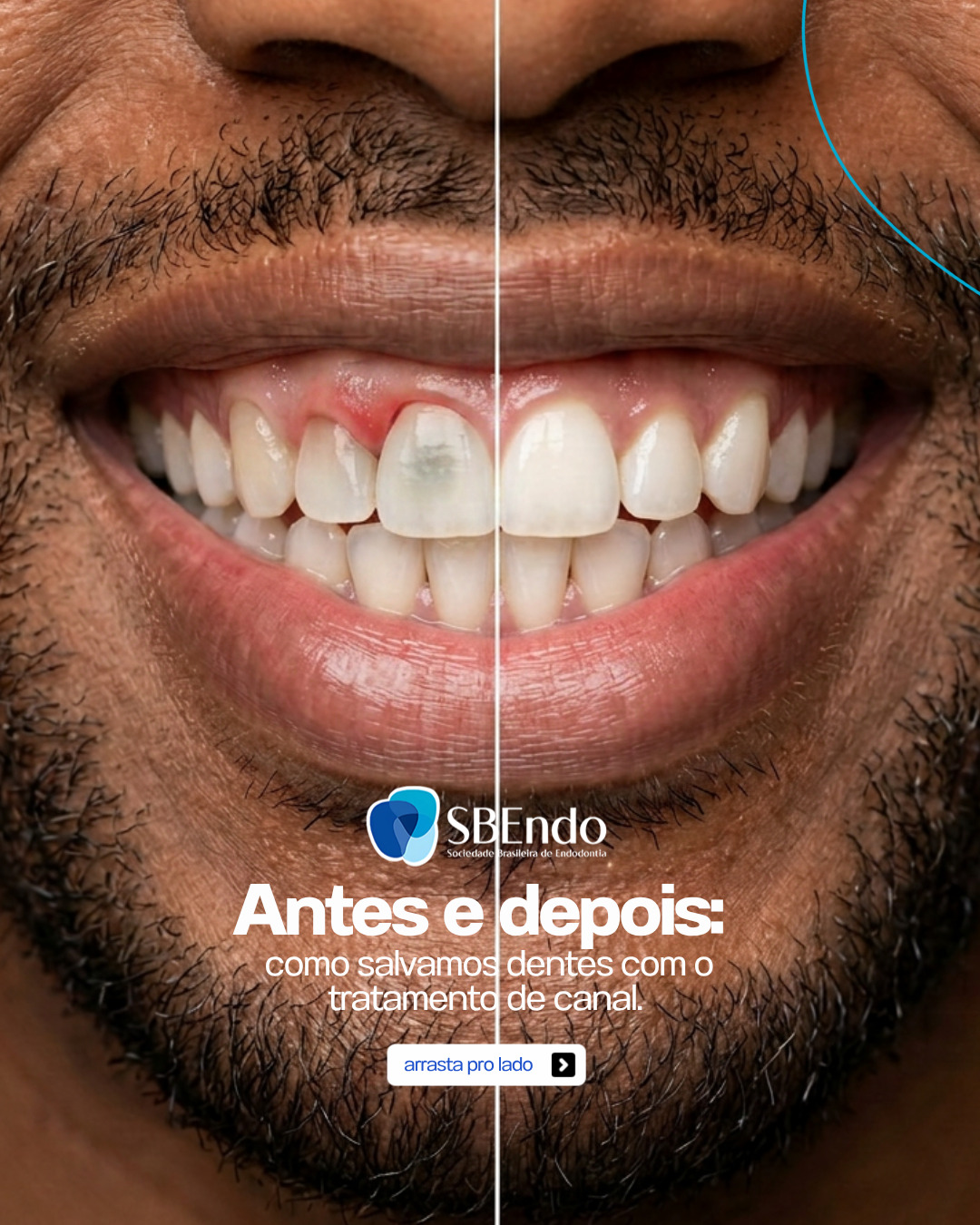 "Esse dente já era, só resta arrancar."
Quantas vezes você já ouviu (ou pensou) isso?
A verdade é que muitos dentes que parecem perdidos podem ser salvos com o tratamento de canal.
O procedimento remove a infecção na raiz e preserva o que é seu — o dente natural, intacto por fora, funcionando normalmente.
Sem extração. Sem prótese substituindo o que já é seu.
A Endodontia existe pra isso: transformar "vou perder o dente" em "consegui salvar".
Confie no especialista em endodontia.
#SBEndo #Endodontia #TratamentoDeCanal #SaúdeBucal #SorrisoSalvo #Odontologia