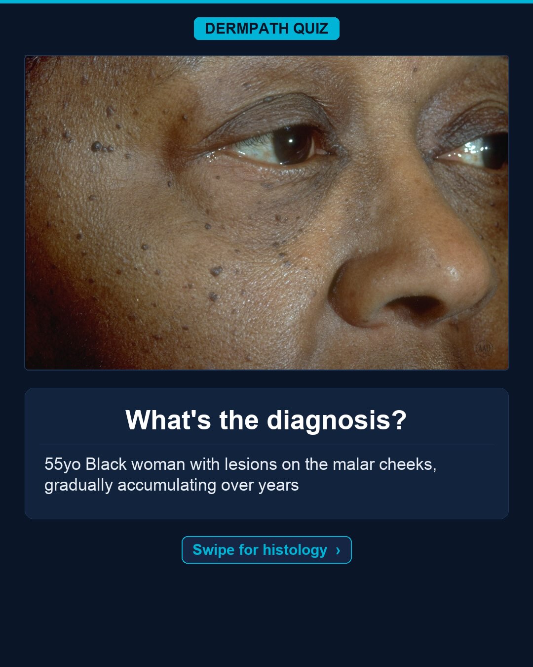 🔬 What’s the diagnosis?
The case: 55yo Black woman with lesions on the malar cheeks, gradually accumulating over years.
Study the clinical photo and the histology, then make your call. Keep swiping for the diagnosis, the labeled slides, and the high-yield pearls.
Your diagnosis? Drop it in the comments before you swipe to the answer 👇
Save this for board review and tag someone who would nail it. Follow for a new dermatopathology case every day.