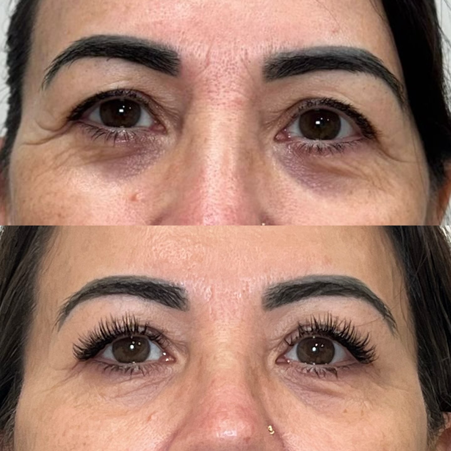 Do you suffer with
• Dark circles
• Under eye creepiness
• Hooded eyelids
• Fine lines & wrinkles
Well we may have an option for you to address these concerns.
We offer free skin & medical consultations in clinic.
There is no obligation to go ahead with treatment.
During your appointment you can discuss your concerns, goals, budget and ask any questions you may have.
To book your appointment you can
• Click the link in our bio for our booking page
• Send us a direct message on here
• Call or text us on 0416447277
• Email us info@barebeautybrisbane.com
📍Bare Beauty Brisbane Aesthetics Clinic
JSM Arcade, 8 Stuart S treet, Bulimba, 4171
📍 Located in SJL Beauty every Tuesday
1A / 354 Main Road, Wellington Point, 4160
#bioregenerative #skintreatments #eyeconcerns #cosmeticclinicbulimba #darkcirclestreatment