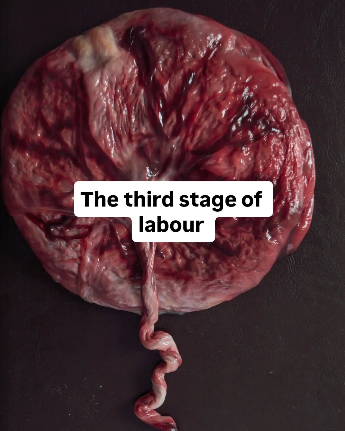 Did you know the third (and final) stage of labour is after the baby is born and you still have to birth the placenta?
It's definitely not thought about as much as birthing the baby.
All of the prep goes into labour and getting baby here but there's a whole stage that comes next, and it deserves just as much thought.
There are options when it comes to birthing your placenta. You can choose a physiological third stage (your body doing its thing) or a managed third stage (an injection of syntocinon).
Alongside and after birthing the placenta there are also other things to know about like optimal cord clamping; skin to skin: initiating breastfeeding; tearing; hemorrhages.
Learning about these things in pregnancy will help you and your birth partner when it comes to making decisions or advocating for your choices in the moment🤰🏻💛
#doulastaffordshire #hypnobirthingburntwood #hypnobirthinglichfield #birthpreparation #empoweredbirth