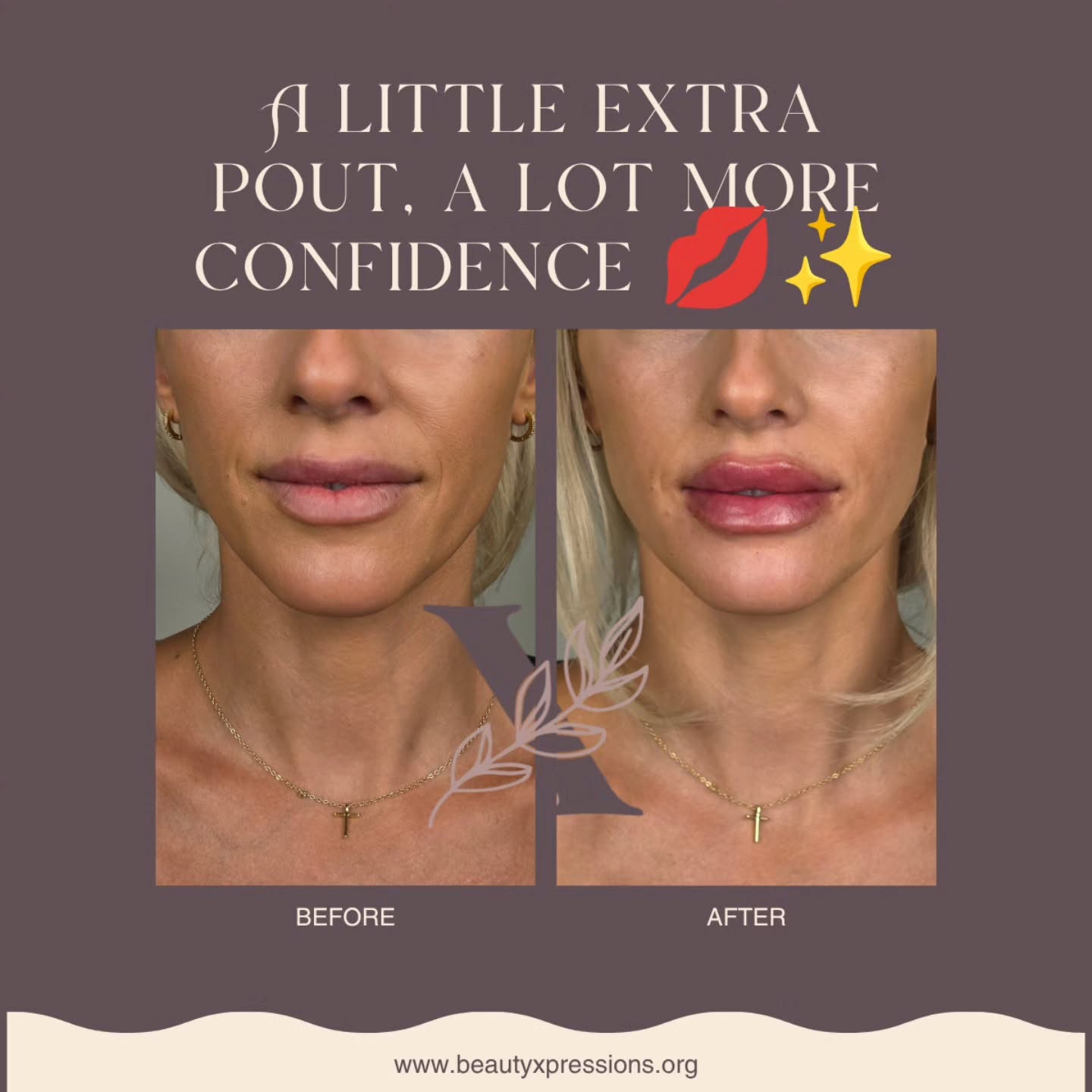 Added a little more height, shape, and plump for a soft pout 💋
The goal was enhanced definition and fullness while keeping the lips balanced.
#lipfillers #injectables #ottawaaesthetics #ottawa #dermalfillers