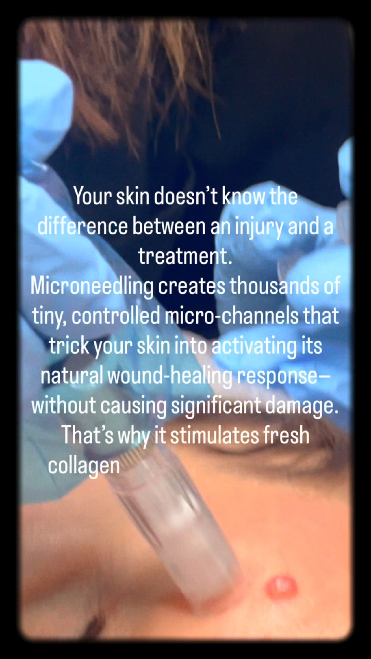 Interesting facts about Microneedling
1. Your skin doesn’t know the difference between an injury and a treatment.
Microneedling creates thousands of tiny, controlled micro-channels that trick your skin into activating its natural wound-healing response—without causing significant damage. That’s why it stimulates fresh collagen and elastin production.
2. Microneedling can make skincare products work up to 10–20 times more effectively.
Those temporary micro-channels allow suitable active ingredients to penetrate much deeper than they would on intact skin. (Only products specifically designed to be used with microneedling should be applied.)
3. Collagen doesn’t appear overnight.
Many people expect instant results, but your skin continues producing new collagen for weeks to months after treatment. That’s why improvements often keep getting better long after the redness has gone.
4. It’s one of the few treatments that can improve scars rather than just disguise them.
Whether it’s acne scarring, surgical scars or stretch marks, microneedling encourages your skin to remodel itself from within, helping to improve texture instead of simply covering the problem.
5. The tiny holes close surprisingly quickly.
Most of the micro-channels created during treatment begin closing within hours, which is why your aftercare during the first 24 hours is so important. Keeping the skin clean and using the correct products can make a real difference to healing.
Ready to master one of the most in-demand skin treatments? Train with us and learn the science behind exceptional microneedling results. DM “MICRONEEDLING” to find out more.
#MicroneedlingTraining
#AestheticsCourses
#TrainInAesthetics
#AestheticTrainingUK
#aestheticcareer