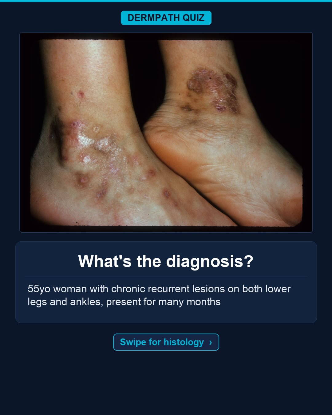 🔬 What’s the diagnosis?
The case: 55yo woman with chronic recurrent lesions on both lower legs and ankles, present for many months.
Study the clinical photo and the histology, then make your call. Keep swiping for the diagnosis, the labeled slides, and the high-yield pearls.
Your diagnosis? Drop it in the comments before you swipe to the answer 👇
Save this for board review and tag someone who would nail it. Follow for a new dermatopathology case every week.
