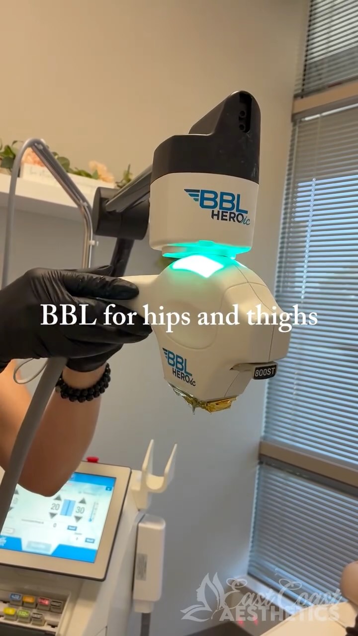 ✨ BBL for Hips & Thighs ✨
Did you know BBL can be used on the hips and thighs to help improve overall skin quality?
This treatment works by targeting pigmentation, redness, and uneven skin tone while stimulating collagen production for smoother, healthier-looking skin!
#eastcoastaesthetics #medspa #medicalaesthetics #bblheroic #beforeandafter