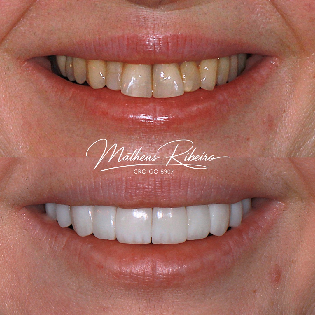 ANTES x DEPOIS ✨
Facetas de Resina para um sorriso mais harmonioso, natural e confiante
Planejamento personalizado para valorizar a estética sem perder a naturalidade
Quer saber se esse tratamento é para você?
Envie “TRANSFORMAÇÃO” aqui nos comentários
#antesxdepois #facetaderesina #odontologiaestética