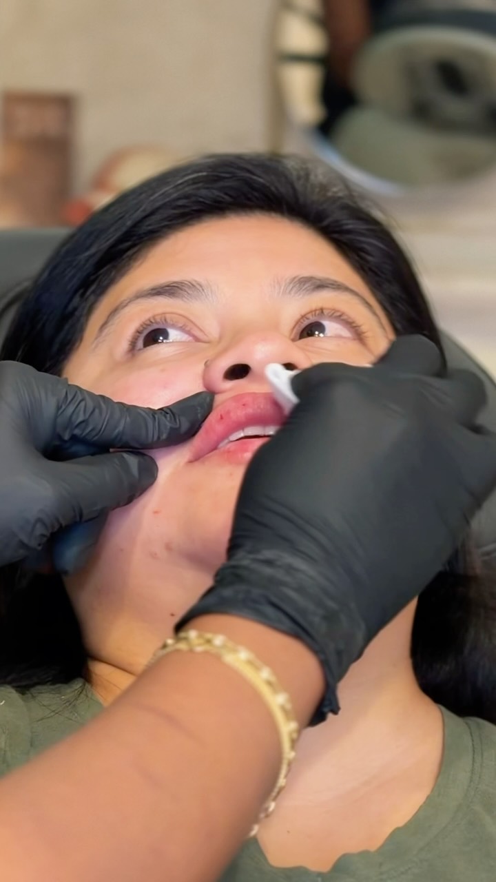 Here was our plan:
1. Improved symmetry: Correct the Right cheek to match the left cheek
2. Use of a bio stimulator to strengthen the tissue in the NLF to reduce folding, softening her smile lines.
3. Chin filler. This beauty had a great chin to begin with. We chose to address her chin to actually make it appear smaller and higher on her jawline. Upon her initial assessment we determined that the distance from her bottom lip to the bottom of her chin was greater than what we wanted and so by adding chin filler we were able to visibly reduce that distance.x
4. Lip Filler: She had beautiful lips to begin with. Adding volume definitely helped balance her lower face and ensuring that the bottom lip stayed larger than the top to continue to reduce the distance from the bottom lip to the chin.
All in all these tiny adjustments work together to add balance. #lipfillerraleigh #medsparaleigh #lipfillercharlotte #lipfillergreensboro