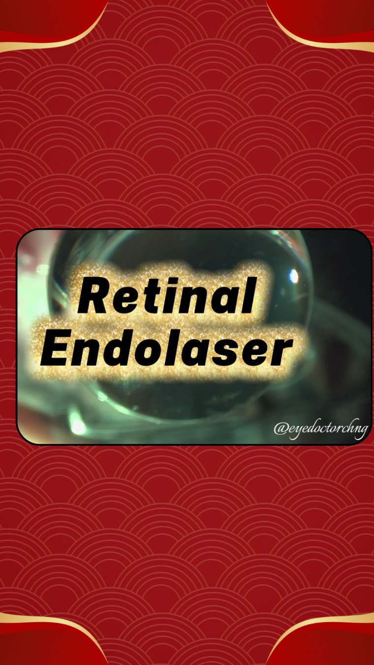 Using the Alcon Unity VCS system tetraspot laser. Quite impressed with it! Definitely saved a few extra minutes when doing a panretinal photocoagulation treatment during a diabetic membrane delamination case.
#vitrectomy #vitreoretinalsurgery #alcon #ophthalmology #eyedoctorchng