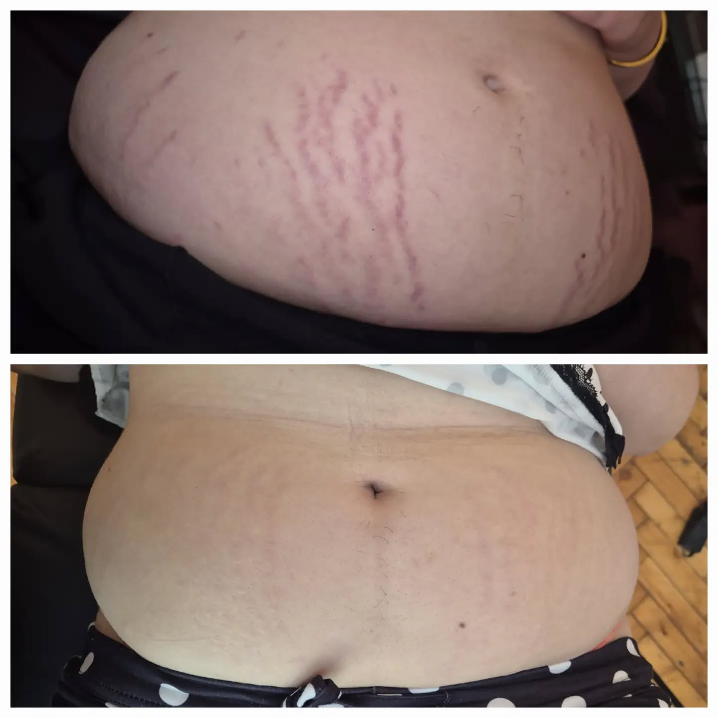 These results are after just 4 sessions of medical-grade microneedling for stretch marks.
Stretch marks are a form of scarring, so they need to be treated at the depth where the damage actually exists. As a medical professional, I am trained and insured to treat stretch marks at depths of up to 2.5 mm where appropriate. This creates controlled micro-injuries within the skin, triggering your body's natural wound-healing response and stimulating the production of new collagen and elastin. Over time, this helps remodel the scar tissue, improving the texture, depth and appearance of stretch marks.
Not all microneedling is the same.
I use the ImedPen, a medical-grade microneedling device fitted with sterile, single-use medical-grade needles. This allows for precise, consistent needle depth and accurate treatment of deeper scar tissue, while maintaining the highest standards of safety and hygiene.
Why choose me?
• Advanced Pharmacist Prescriber with over 11 years of NHS experience.
• Over 7 years of experience in medical aesthetics.
• Medical-grade equipment and evidence-based treatment protocols.
• Treatments tailored to your skin, not a one-size-fits-all approach.
• Honest expectations – stretch marks take time to improve, but with the right treatment plan, significant improvements are possible.
Every treatment plan is personalised, and the number of sessions required will depend on the age, colour and severity of your stretch marks.
If you've been thinking about treating your stretch marks, send me a message to book a consultation and let's discuss whether medical-grade microneedling is the right option for you.