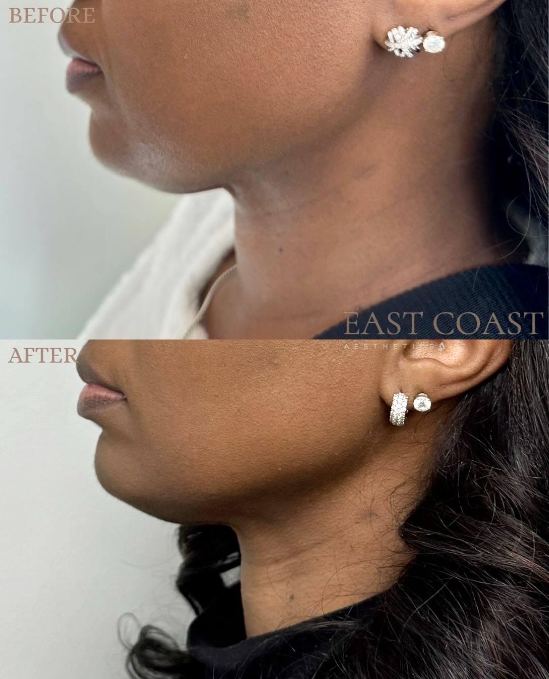 A little Botox goes a long way ✨📐
This patient received jawline Botox for a more sculpted, defined profile. A subtle treatment that makes a noticeable difference!
#eastcoastaesthetics #medspa #medicalaesthetics #jawlinebotox #botox