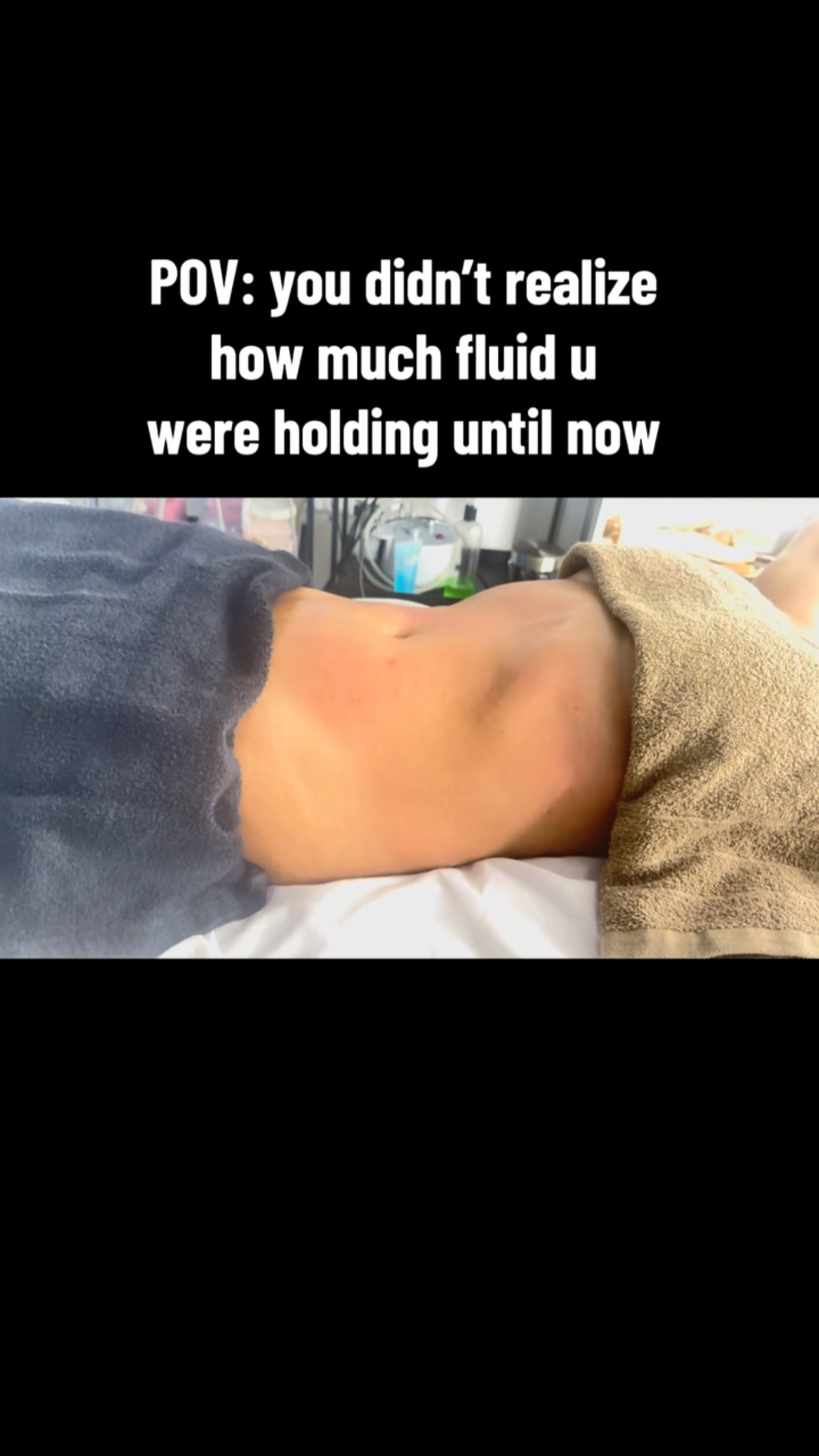 Friendly reminder that inflammation, stress, and extra sodium can completely hide your progress. Don’t let a temporary puff fool you! 💪
#lymphaticmassage #lymphaticdrainage #postopcare #bodycontouring #lymphaticdrainagemassage