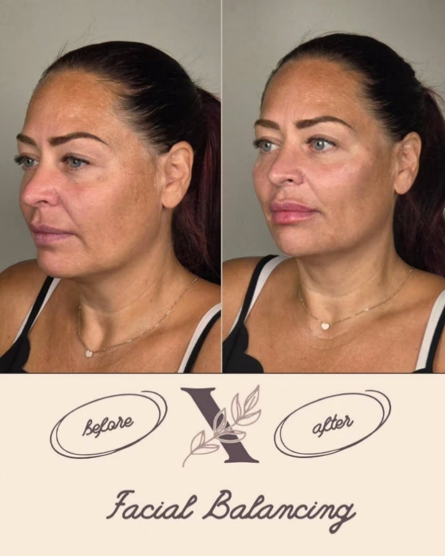Some lovely work done at the Academy today ❤️
Facial balancing is about enhancing—not changing—what makes you uniquely beautiful. ✨
By placing soft, strategic amounts of dermal filler in all the right areas, we can create a more refreshed and harmonious appearance while balancing the upper, mid, and lower face.
The goal is subtle restoration, improved proportions, and natural-looking results that help you look like yourself—just a little more rested, balanced, and refreshed. 🤍
#dermalfillers
#aesthetics #ottawaaesthetics #injectables #ottawa