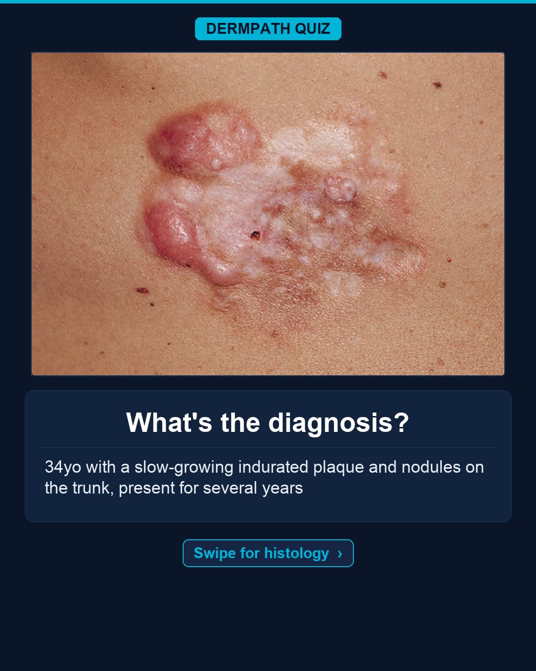 🔬 What’s the diagnosis?
The case: 34yo with a slow-growing plaque on the trunk, present for several years.
Study the clinical photo and the histology, then make your call. Keep swiping for the diagnosis, the labeled slides, and the high-yield pearls.
Your diagnosis? Drop it in the comments before you swipe to the answer 👇
Save this for board review and tag someone who would nail it. Follow for a new dermatopathology case every week.