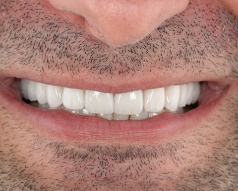 Porcelain veneers 😍
