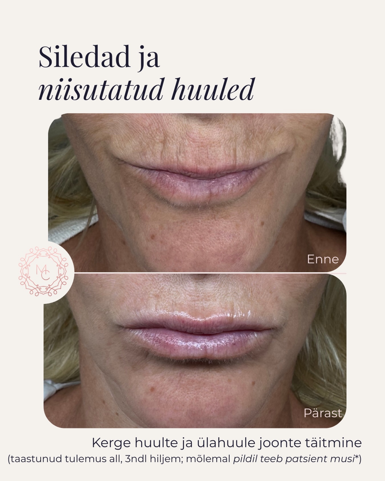 ✨ Loomulikult niisutatud huuled ei tähenda alati suuremat volüümi.
Mõnikord piisab vaid väikesest kogusest täitesüstist, et taastada huulte niisutatus, siluda peened ülahuule jooned ja värskendada kogu ilmet.
Selle patsiendi puhul keskendusime:
💉 huulte loomulikule niisutamisele;
💉 kergele volüümi taastamisele;
💉 ülahuule peente vertikaalsete joonte pehmendamisele.
Tulemus on pehme, harmooniline ja loomulik – just selline, mis ei muuda inimest, vaid toob esile tema enda ilu.
📸 Pildil on taastunud tulemus 3 nädalat pärast protseduuri. Mõlemal fotol teeb patsient huultega sama miimikat.
Kas ka Sina oled märganud, et huulepulk kipub peenetesse ülahuule joontesse kogunema või huuled tunduvad ajaga kuivemad ja õhemad? Konsultatsioonil leiame just Sulle sobiva lahenduse.
#medicinakliinik #huultetäitesüstid #hüaluroonhape #loomuliktulemus #ülahuulekortsud