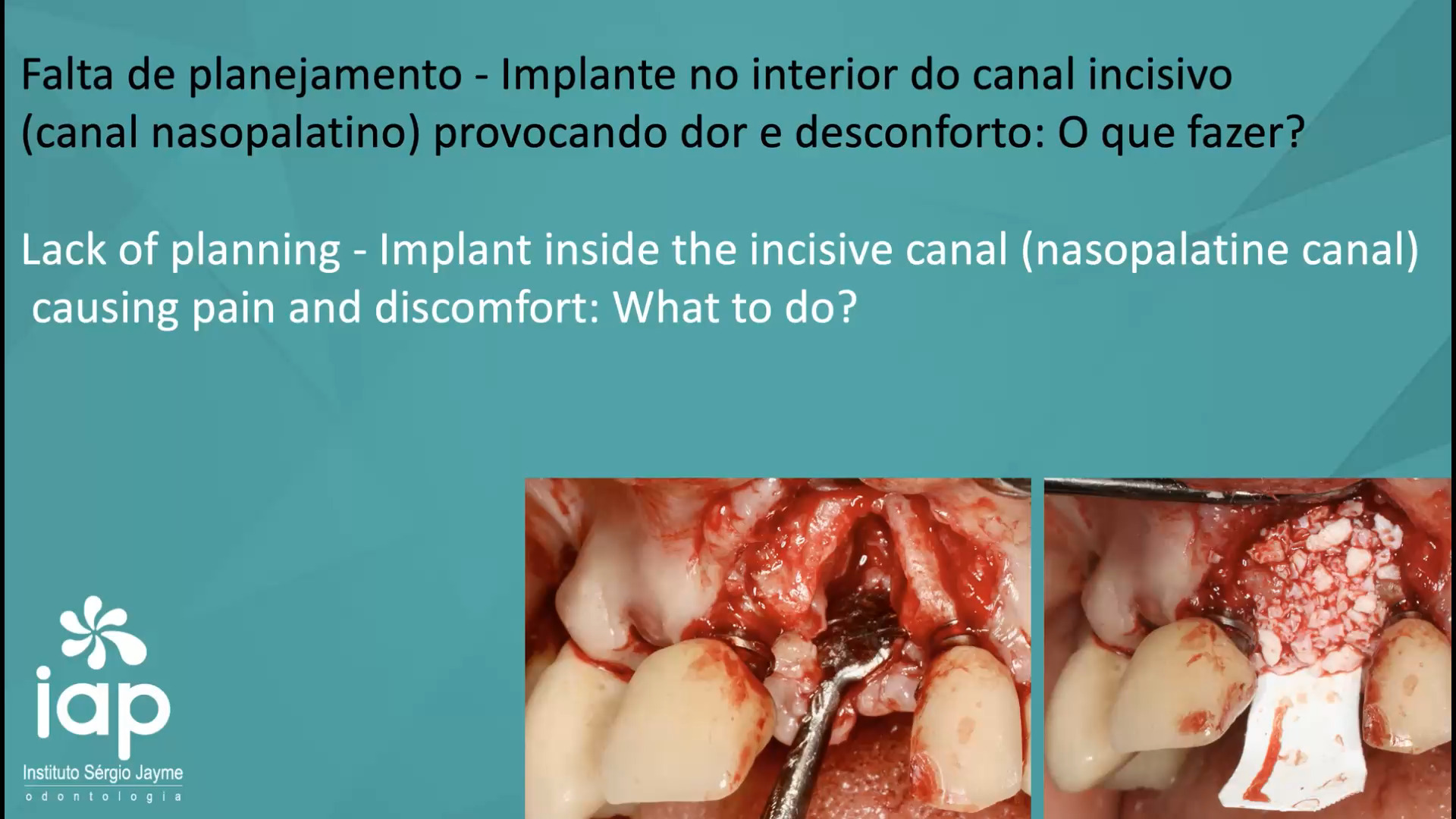Falta de planejamento - Implante no interior do canal incisivo (canal nasopalatino) provocando dor e desconforto: O que fazer?
Implante instalado na região do dente 21 e penetrou o canal incisivo (canal nasopalatino), provocando dor e desconforto, estamos diante de uma complicação relativamente rara, mas geralmente relacionada à falta de planejamento tridimensional.
O que aconteceu?
O canal incisivo contém:
• Nervo nasopalatino.
• Artérias e veias nasopalatinas.
• Tecido conjuntivo neurovascular.
Quando um implante invade esse canal, o paciente pode apresentar:
• Dor persistente.
• Sensação de pressão palatina.
• Desconforto à mastigação.
• Ardência ou parestesia na região anterior do palato.
• Dor ao toque na papila incisiva.
O que fazer?
1. Confirmar o diagnóstico com CBCT
Avaliar:
• Grau de invasão do canal.
• Posição apical e tridimensional do implante.
• Presença de lesão neurovascular.
• Osseointegração inicial do implante.
2. Avaliar intensidade dos sintomas
Paciente assintomático
• Em alguns casos pode ser apenas acompanhado.
Paciente sintomático (dor e desconforto persistentes)
• A remoção precoce costuma ser a conduta mais previsível.
3. Remoção do implante
Quando existe:
• Dor contínua.
• Sintomas neurossensoriais.
• Compressão evidente do feixe neurovascular.
A remoção do implante geralmente leva à resolução dos sintomas.
Como evitar?
Planejamento digital pré-operatório:
• CBCT obrigatória na região anterior da maxila.
• Identificação do diâmetro do canal incisivo.
• Avaliação do trajeto do canal.
• Guia cirúrgico em situações limítrofes.
Cirurgia realizada no IAP-Sérgio Jayme
Dr. Sérgio Jayme Av. Paulista, 91 Cj 402
Tel (11)5572-1283 / Cel e WhatsApp (11)94888-2000
CEP:01311-000 • São Paulo-SP
Av. Rubem Berta, 1461
Tel (11)2276-2217 / Cel e WhatsApp (11)98383-3941
CEP: 04074-010 • São Paulo-SP
#implante #curso #iap #protesedental #protesedentaria #sergiojayme #sergiojaime #cienciaemvideo #implantesdentarios #implantes #implant #implants #implantdentistry #implantology #implantodontia #iatrogenia #nobelbiocare #geistilich #canalnasopalatino #canalincisivo