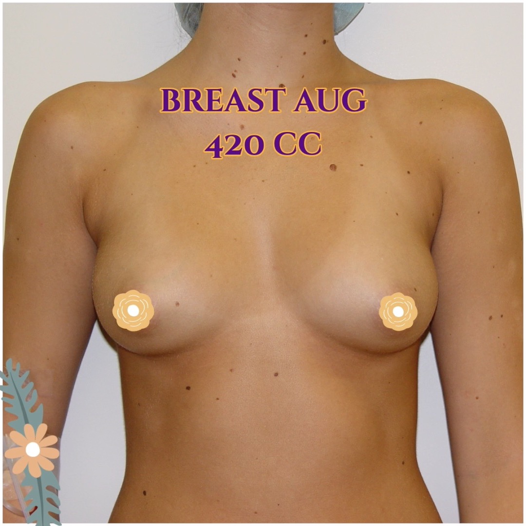 Call now for our Mid-Summer Specials! Saline Breast Aug -->$3995 Silicone Breast Aug --> $6495 Tummy Tuck starts at --> $7995. Call (714) 500-0050 #drluudoan #breastaug #salineimplants #siliconegelimplants #tummytuck #abdominoplasty