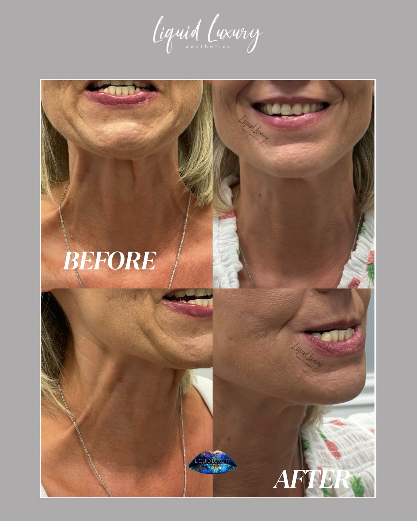 A more defined jawline without surgery? It might be time to learn about the Nefertiti Lift. โจ
The Nefertiti Lift is an advanced tox technique that uses Jeuveau to relax the muscles that pull the jawline and neck downward. By reducing this downward pull, the treatment can create the appearance of a smoother neck and a more lifted, defined jawline while maintaining natural looking results.
Every face is unique, which is why your treatment plan should always be customized to your anatomy and aesthetic goals.
@jeuveaubyevolus
๐ (631) 760-1124
๐ www.liquidluxuryaesthetics.com
๐ 1030 W Jericho Tpke Suite 5 Smithtown, NY 11787
๐ง info@liquidluxuryaesthetics.com
๐ฉ๐ผโโ๏ธ Ina LaRocca-Tocco, FNP-C
๐คณ TikTok: liquidluxury_aesthetics
#Jeuveau #NefertitiLift #JawlineContour #MedicalAesthetics #NaturalResults