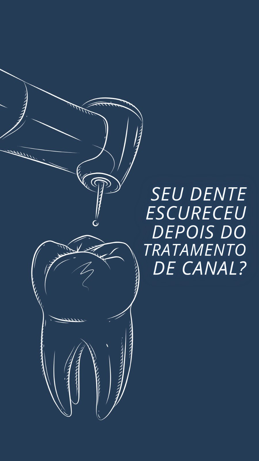 Seu dente escureceu depois do tratamento de canal? 🦷
Muita gente acredita que não há mais o que fazer. Mas, em muitos casos, é possível devolver uma aparência muito mais próxima da cor natural do dente.
Existem tratamentos específicos para esse tipo de escurecimento, e a melhor opção depende da avaliação de cada caso.
Quer saber como isso é feito e quando o tratamento é indicado?
▶️ Assista ao vídeo e descubra como recuperar a estética do seu sorriso. ✨
