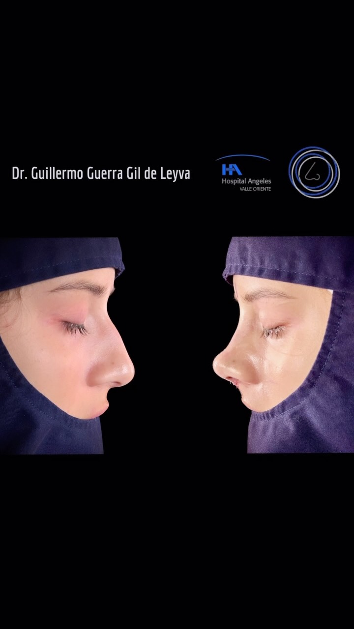 🔹Cada procedimiento es personalizado, planificado con precisión y ejecutado con técnica y experiencia. La Rinoplastia es arte y ciencia combinados.
🔹Resultado inmediato Rinoplastia Estética y Funcional.
🔹 Gracias a mi excelente paciente por su confianza y permitir compartir su resultado.
🔹”Made by hand. Crafted with passion”
🧑⚕️ Dr. Guillermo Guerra Gil de Leyva
🏥 Hospital Ángeles Valle Oriente
📱 81-1252-0132
🎓Universidad de Monterrey
👃 Rinoplastia Estética y Funcional
🚫 No taponamiento
Cédula Profesional: 3070499
Cédula Especialista: 4503273
No. Certificación CONACEM: GUG-1748/04
Aviso de Publicidad COFEPRIS: 2419032002A00111
❕Paciente autoriza difusión de imágenes con fines académicos e informativos.
❕Los resultados finales se pudieran observar hasta un año de la cirugía y dependerá tanto del compromiso del cirujano como del paciente, así como del tipo de cirugía, tipo de piel, cuidados post-operatorios, etc.
#CirugíaFacial #RinoplastiaEspecializada
#rinoplastia #rhinoplasty #septoplastia septoplasty rinoseptumplastia rhinoseptoplasty nosejob nose nosesurgery tabiquenasal otorrinolaringologia entsurgery cirugianasal cirugiatabique cirugiaesteticanasal
belleza confianza autoestima
cosmeticsurgery
otorrinolaringologiamonterrey otorrinomonterrey beforeandafter antesydespues
estructuredrhinoplasty
rinoplastiaestructurada
rinoplastiaultrasonica
ultrasonicrhinoplasty
