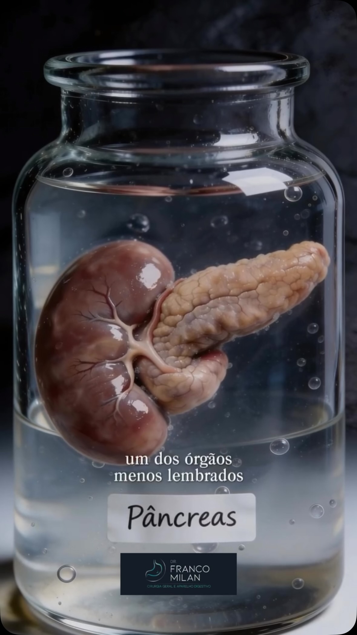 🧬 O pâncreas é um órgão extremamente importante do nosso corpo, mas poucas pessoas sabem exatamente o que ele faz.
Ele tem duas funções essenciais: produz enzimas que ajudam na digestão dos alimentos e hormônios, como a insulina, que controlam os níveis de açúcar no sangue.
Quando o pâncreas não funciona adequadamente, podem surgir problemas como pancreatite, diabetes e insuficiência pancreática, afetando diretamente a digestão e a qualidade de vida.
Conhecer o papel desse órgão é o primeiro passo para entender a importância de cuidar da sua saúde digestiva.
⚠️ Se você apresenta dor abdominal persistente, perda de peso sem explicação, diarreia gordurosa ou alterações importantes na glicemia, procure avaliação médica. O diagnóstico precoce faz toda a diferença.
#Pancreas #SaudeDigestiva #Gastroenterologia #CirurgiaDoAparelhoDigestivo #Digestao