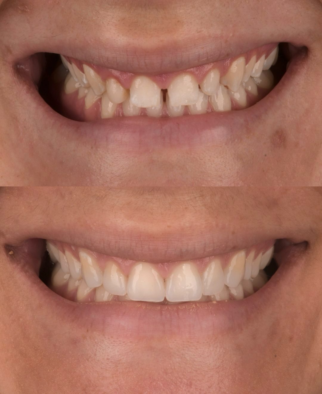 LAYERING & INJECTION
🇫🇷
Après un allongement coronaire permettant d’harmoniser le niveau des gencives, nous avons réalisé 10 composites stratifiés et injectés pour redonner au sourire une esthétique naturelle.
📩 Envoyez-moi un DM pour vous inscrire à la prochaine formation sur la stratification et l’injection des composites.
⸻
🇬🇧
Following crown lengthening to rebalance the gingival levels, we restored the smile with 10 layered and injection-molded composite restorations, achieving a natural and harmonious result.
📩 DM me to join the next Composite Layering & Injection course.