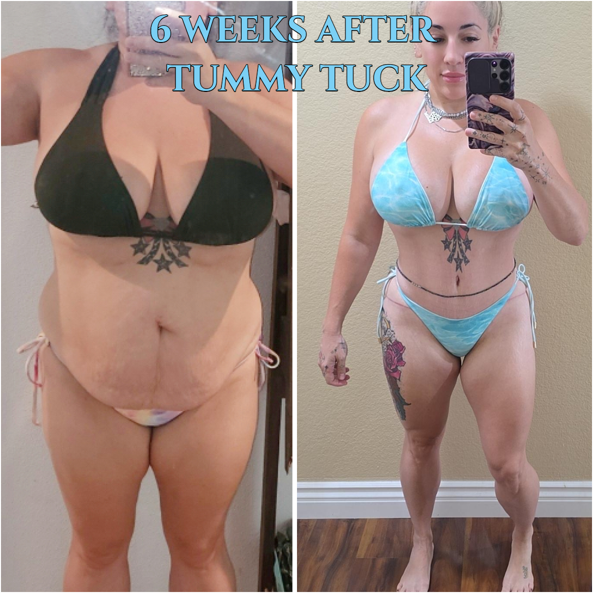 Just 6 weeks after her tummy tuck, lipo of love handles, and rectus muscle tightening, she's ready to hit the beach and the gym! Call now for our Mid-Summer Specials! Saline Breast Aug -->$3995 Silicone Breast Aug --> $6495 Tummy Tuck starts at --> $7995. Call (714) 500-0050 #drluudoan #breastaug #salineimplants #siliconegelimplants #tummytuck #abdominoplasty