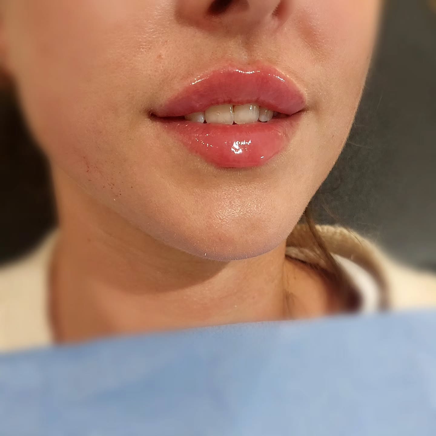 Lip Filler; Natural Enhancing
#lipfillerinbristol #fillersinbristol #dermalfillerinjections #bristollipfiller
Exploring the options for lip filler in Bristol feels like a significant step toward achieving that confidence boost. I'm keen to understand the different types of dermal filler available and their suitability. My focus remains firmly on achieving a natural enhancing result. This journey into lip filler in Bristol is all about subtle refinement.