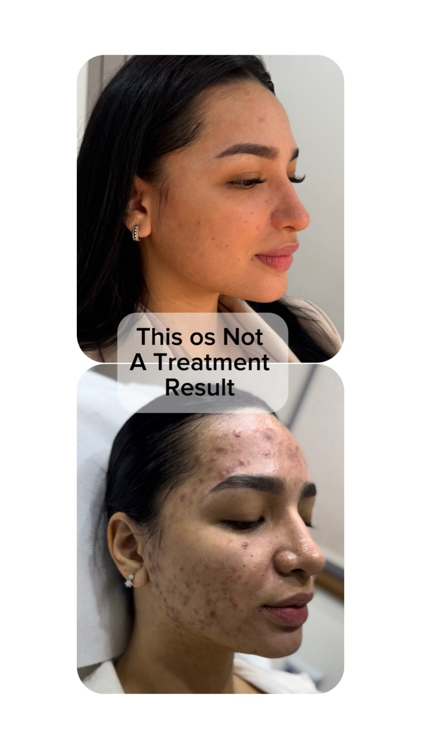 🔺This is NOT A Treatment result❌
🟢It’s the result of three decisions made correctly
✔️ The right diagnosis.
✔️ Choosing the treatment that matched the diagnosis and the stage of condition
✔️ Following a treatment plan consistently and giving it enough time to work.
This transformation didn’t happen after one session or one product. It was built over more than a year.
That’s why I always tell my patients: don’t come looking for a specific treatment. Come with your concern.
✅Your diagnosis should guide the treatment—not the other way around.
❌The best results rarely come from finding a “magic” treatment. They come from a thoughtful plan, patience, and consistency.
.
.
.
#acnetreatments #regenerativetreatment #skin #scartreatment