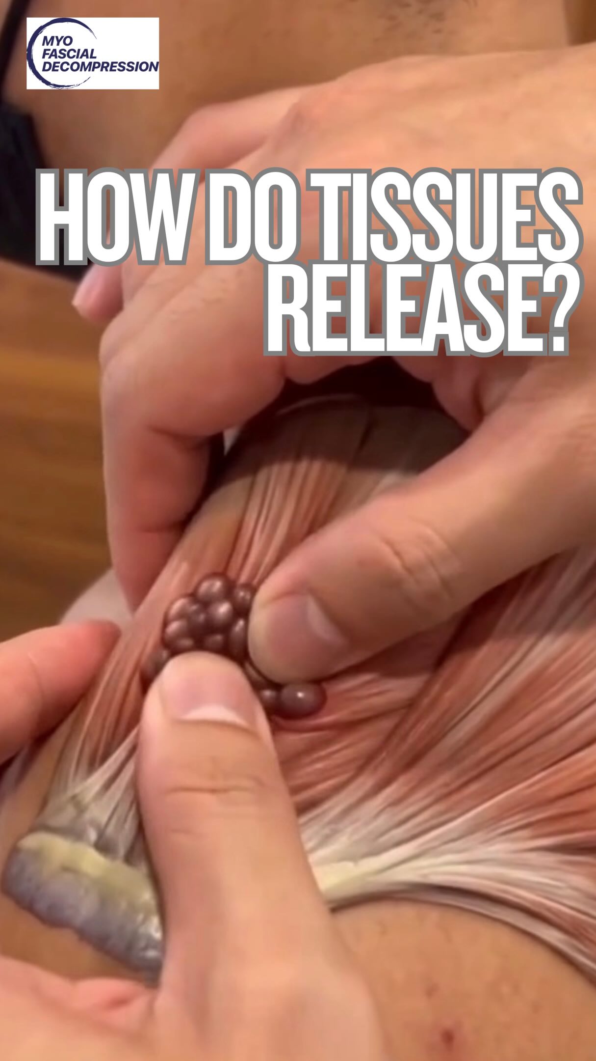 That deep “release” during manual therapy or IASTM may feel like some tangled up knot just came undone, which is a satisfying story, but not quite at all what happens.
Your muscles and connective tissue aren’t just a bunch of ropes getting knotted. Between these fibers sits ground substance — a gel made of proteoglycans, water, and sugar chains — basically the biological cousin of Jell-O. Structural, but squishy, and built to change consistency under stress or load.
Mechanical pressure like manual therapy transfers energy into the tissue, exciting its molecules until they move faster and the material temporarily thins out and glides more easily. Ketchup does this. Honey does this. Your fascia does this. Nothing was untangled — it just got, briefly, more cooperative.
That cupping “release” was simply thixotropy doing its thing, not demolition and not untying the knots or adhesions. Come learn the real science and skip the fluff! Link in BIO