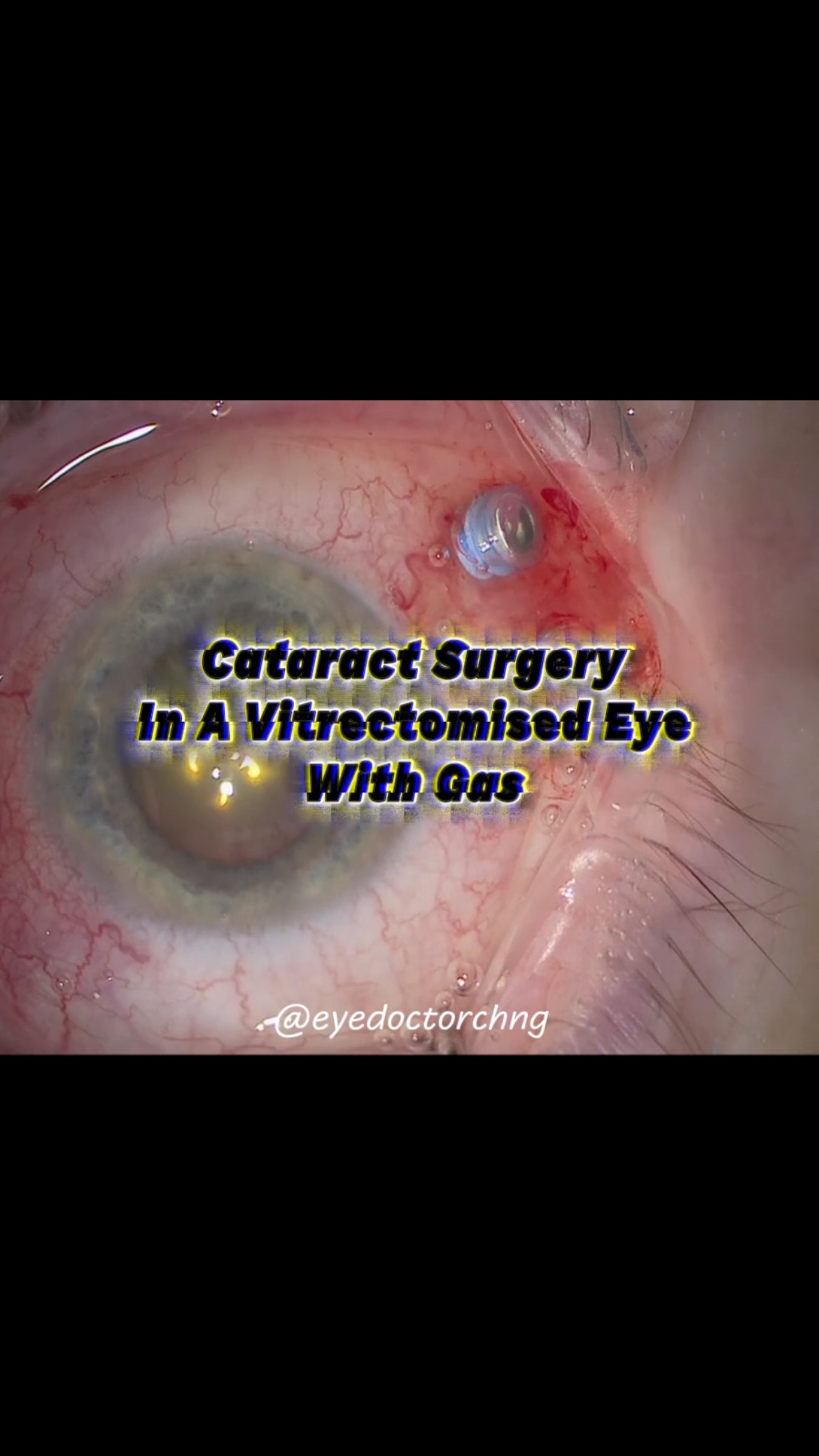 Cataract surgery in a post vitrectomised eye with a retinal re-detachment and remnant of gas in the vitreous cavity.
#cataractsurgery #vitreoretinal #eyesurgery #ophthalmology #eyedoctorchng