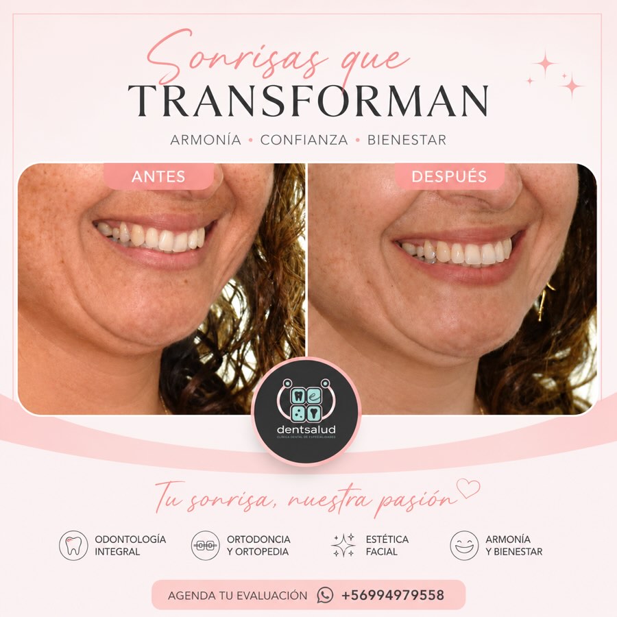 ✨ Anímate a dar el paso hacia el cambio!
Una sonrisa armónica no solo transforma tu imagen, también fortalece tu confianza y bienestar. 💖
Cada tratamiento es personalizado para resaltar lo mejor de ti, respetando tu esencia y cuidando cada detalle.
📍En Dentsalud estamos listos para acompañarte en este proceso.
📲 Agenda y descubre cómo una pequeña transformación puede hacer una gran diferencia ❤️
Tu sonrisa, nuestra pasión. 🦷✨
#AntesYDespués #SonrisasQueTransforman #DiseñoDeSonrisa #OdontologíaEstética #Ortodoncia