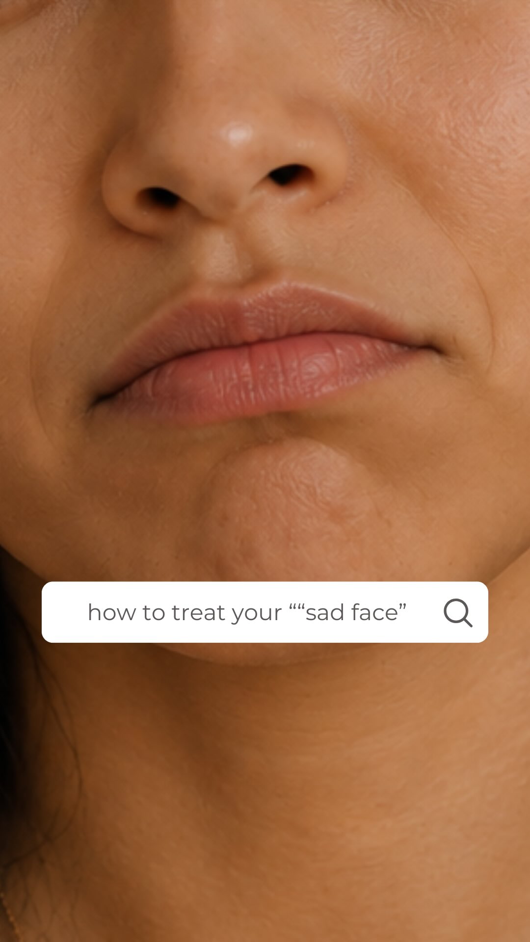 If your corners are starting to pull down and your resting face looks sadder than you feel — this one’s for you. 🤍
There are actually a few things happening in the lower face that create that “sad face” look, and the good news? All of them are treatable.
↓Depending on what you’ve got going on, we can address these with a combination of toxin to relax overactive muscles, subcision, dermal filler (HA or Radiesse), or all of the above.
It’s not one-size-fits-all; it’s a plan built around your face.
Come in for a consult and we’ll map out exactly what your lower face needs. 👩⚕️
#medspahawaii #honoluluskincare #hawaiiskincare #hawaiiaesthetic #medspahonolulu