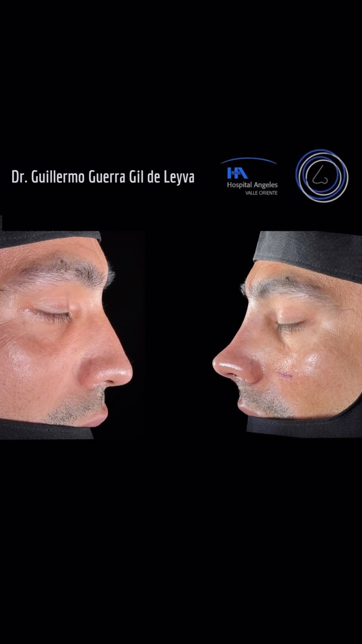 🔹Resultado inmediato de Cirugía Nasal Estética y Funcional secundaria con antecedente de cirugía previa.
🔹 Gracias a mi excelente paciente por su confianza y permitir compartir su resultado.
🔹”Made by hand. Crafted with passion”
🧑⚕️ Dr. Guillermo Guerra Gil de Leyva
🏥 Hospital Ángeles Valle Oriente
📱 81-1252-0132
🎓Universidad de Monterrey
👃 Rinoplastia Estética y Funcional
🚫 No taponamiento
Cédula Profesional: 3070499
Cédula Especialista: 4503273
No. Certificación CONACEM: GUG-1748/04
Aviso de Publicidad COFEPRIS: 2419032002A00111
❕Paciente autoriza difusión de imágenes con fines académicos e informativos.
❕Los resultados finales se pudieran observar hasta un año de la cirugía y dependerá tanto del compromiso del cirujano como del paciente, así como del tipo de cirugía, tipo de piel, cuidados post-operatorios, etc.
#rinoplastia #rhinoplasty #septoplastia #septoplasty #rinoseptumplastia rhinoseptoplasty nosejob nose nosesurgery tabiquenasal otorrinolaringologia entsurgery cirugianasal cirugiatabique cirugiaesteticanasal
belleza confianza autoestima
cosmeticsurgery
otorrinolaringologiamonterrey otorrinomonterrey beforeandafter antesydespues
estructuredrhinoplasty
rinoplastiaestructurada
rinoplastiaultrasonica
ultrasonicrhinoplasty