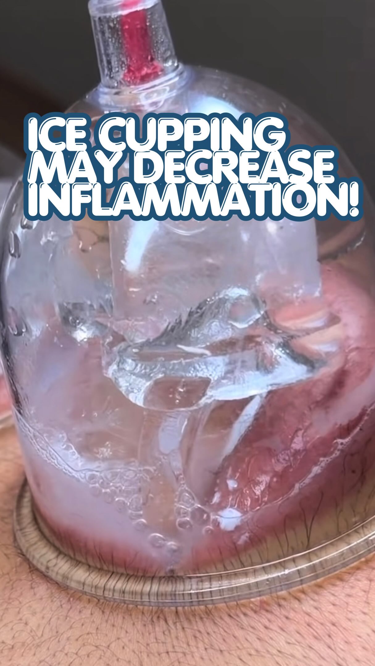 The only thing ice cupping might be helping with is slowing down your consumption of cocktails! 😅 Ice cubes in your cups?!? Sure. Let’s chill the exact response you just set out to create.
⭕️
Here’s the part nobody’s putting in their Reel: negative pressure works because it creates a controlled local inflammatory signal — that’s not a side effect, that’s the mechanism. Now dump ice on it. Vasoconstriction kicks in, local blood flow drops, and you’ve just told the exact cells you wanted to show up to sit back down. You didn’t “reduce inflammation.” You blunted the adaptive signal your treatment was designed to trigger.
⭕️
Cryotherapy has its place. It is not inside your cup, sabotaging your own mechanism, thirty seconds after you created it.
Load the tissue. Let biology do biology. Save the ice for your cocktails. 🧊🚫 what the CUP 🤦🏽♂️