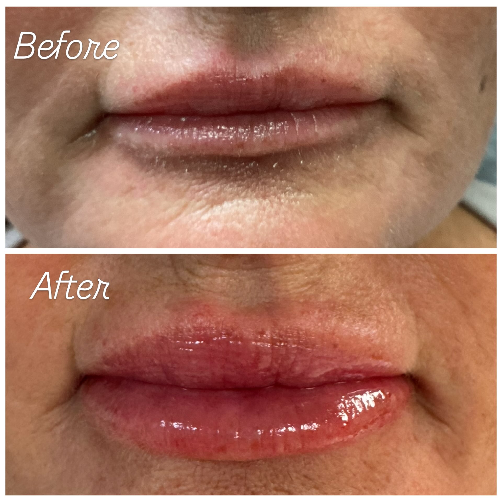 She wanted us to balance her bottom lip to her top lip…Juvederm .55mL in the bottom was used💉💋
