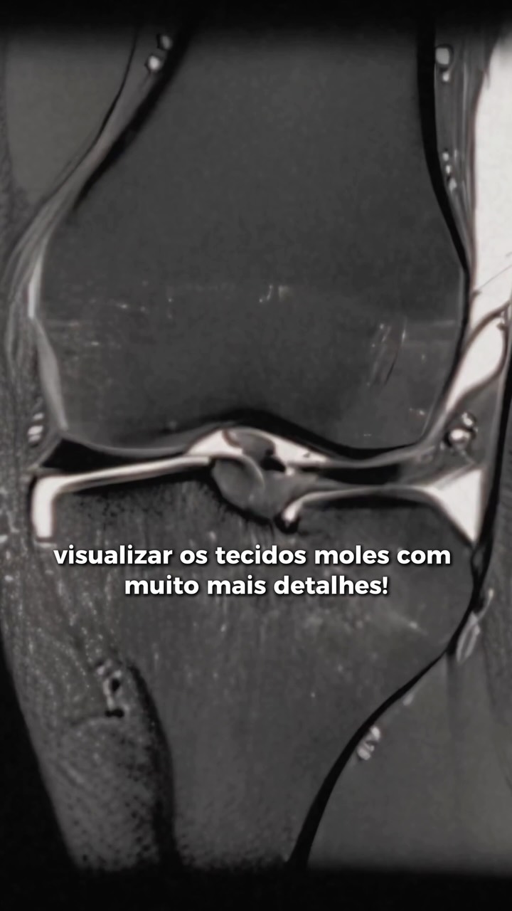 Você já ouviu a frase: “Seu raio-X deu normal, então está tudo bem”?
Nem sempre é assim.
O raio-X é um exame excelente para avaliar os ossos, mas algumas das principais causas de dor no joelho podem estar em estruturas que ele não consegue mostrar, como meniscos, ligamentos, cartilagens e tendões.
É por isso que, em alguns casos, a ressonância magnética é o exame mais indicado para investigar a verdadeira origem da dor.
Mais importante do que fazer vários exames é realizar o exame certo, no momento certo. Um diagnóstico preciso faz toda a diferença para que o tratamento seja direcionado à causa do problema.
💬 Você ou alguém da sua família já passou por essa situação? Conte nos comentários!
#iradi #institutoderadiologiadetoledo #toledo #raiox #ressonanciamagnetica