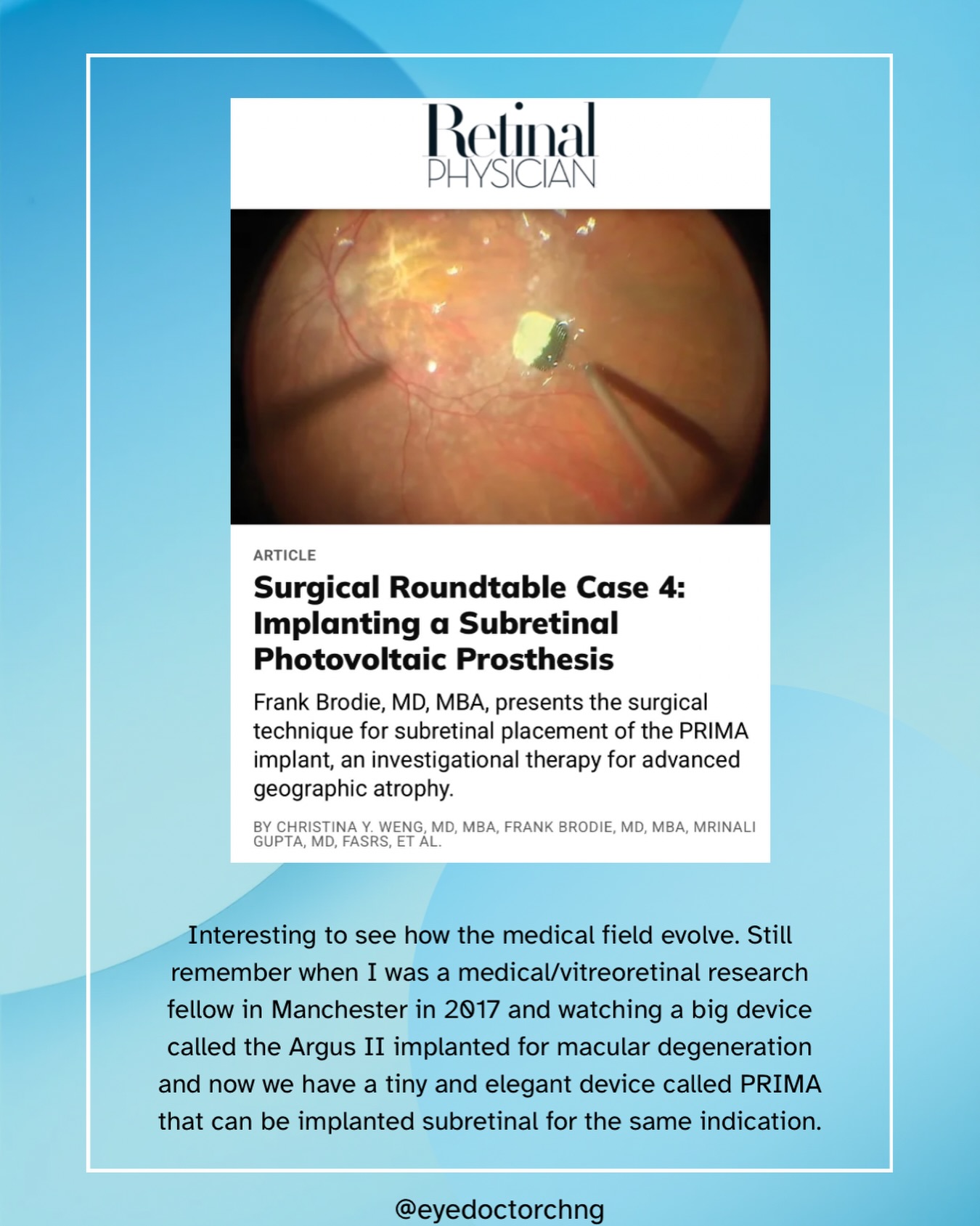 Very elegant new advancement in the ophthalmology surgical view to help geographic atrophy in macular degeneration. Visit the website below to learn more and watch the video on how the PRIMA subretinal implant works and the surgical technique.
https://www.retinalphysician.com/issues/2026/july-august/roundtable-case-4/
#surgicaltechnology #ophthalmology #maculardegeneration #retinalphysician #eyedoctorchng