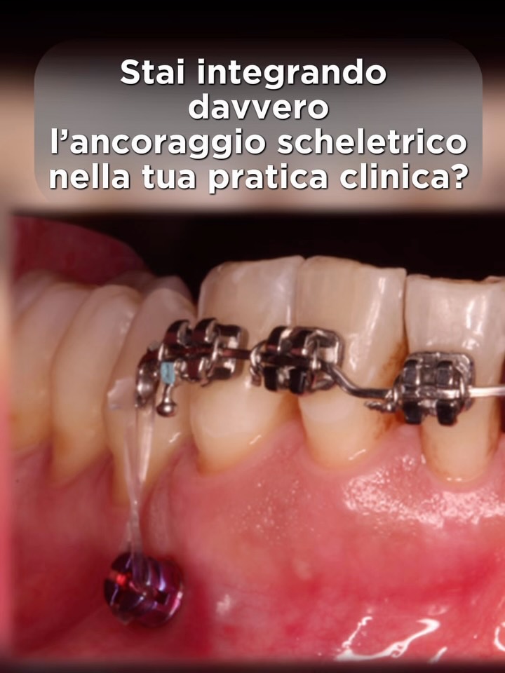 Due corsi sull’ancoraggio scheletrico con il Dr. Giorgio Iodice
📍Firenze
📆 25-26 settembre 2026
#ortodonzia #ancoraggioscheletrico #ancoraggiopalatale
